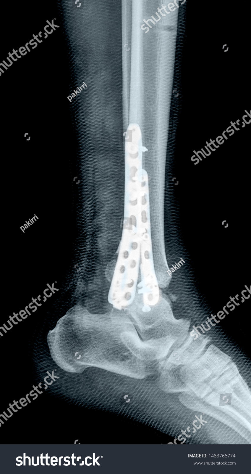 Tibia Perone Fracture Xray Stock Photo 1483766774 | Shutterstock