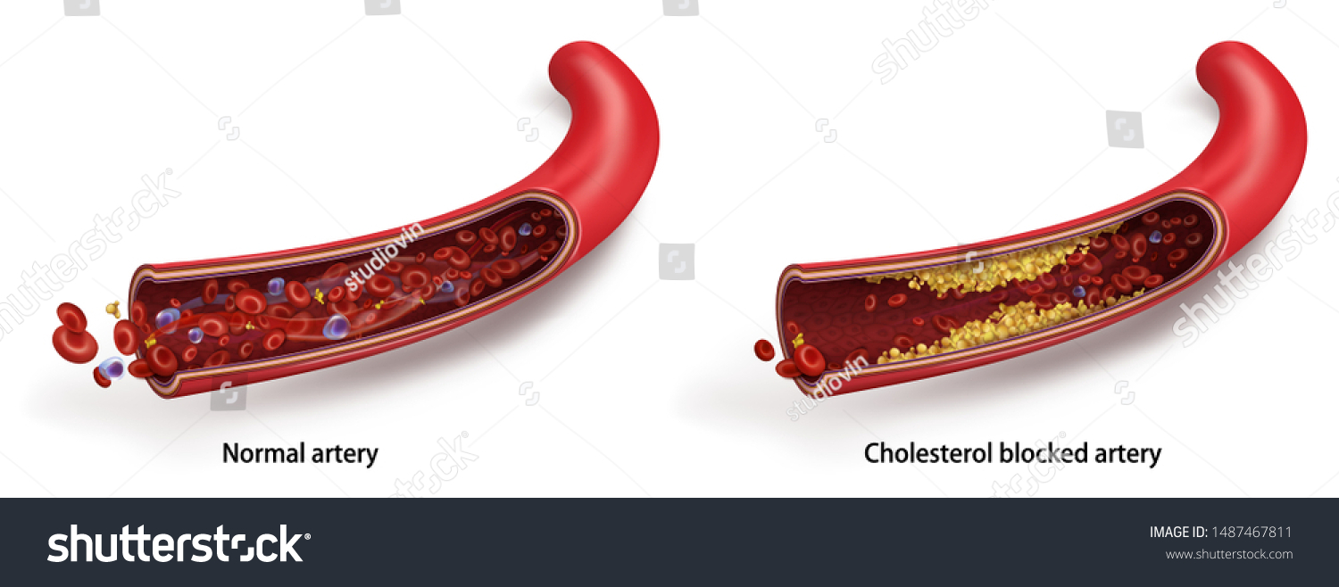 Normal Blood Flow Accumulation Cholesterol Blood Stock Vector Royalty