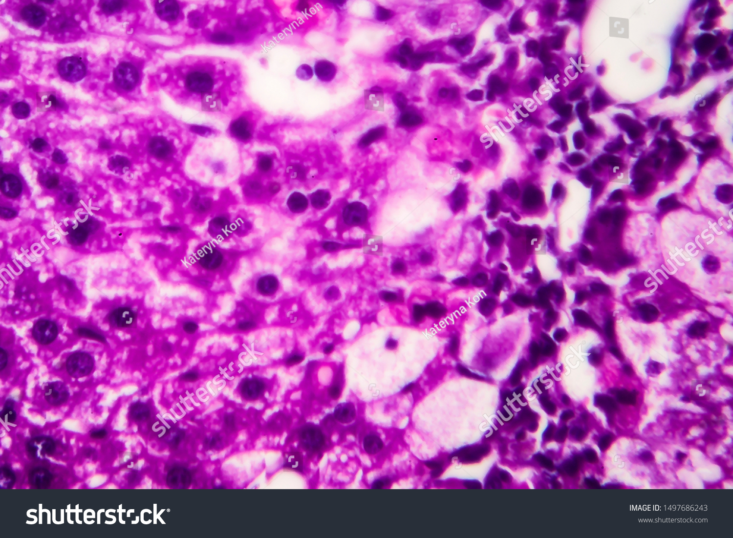 Histopathology Acute Hepatitis Light Micrograph Photo Stock Photo ...