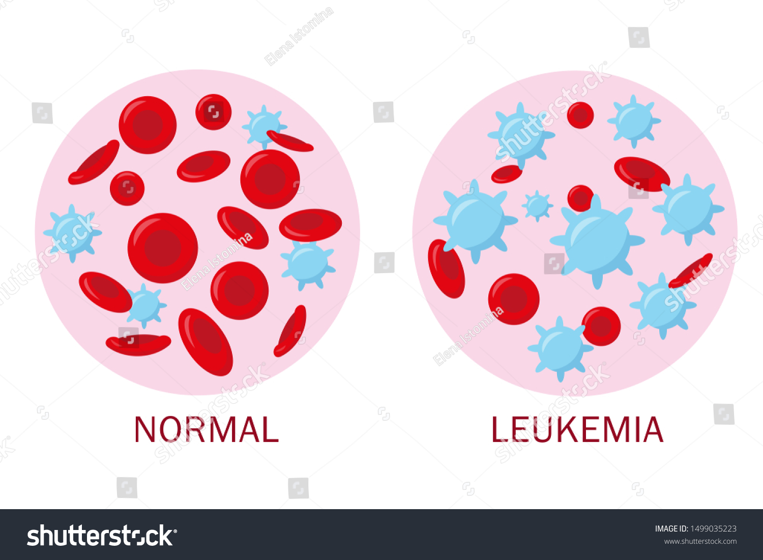 Tubes Normal Blood Leukemia Blood Medical Stock Vector (Royalty Free ...