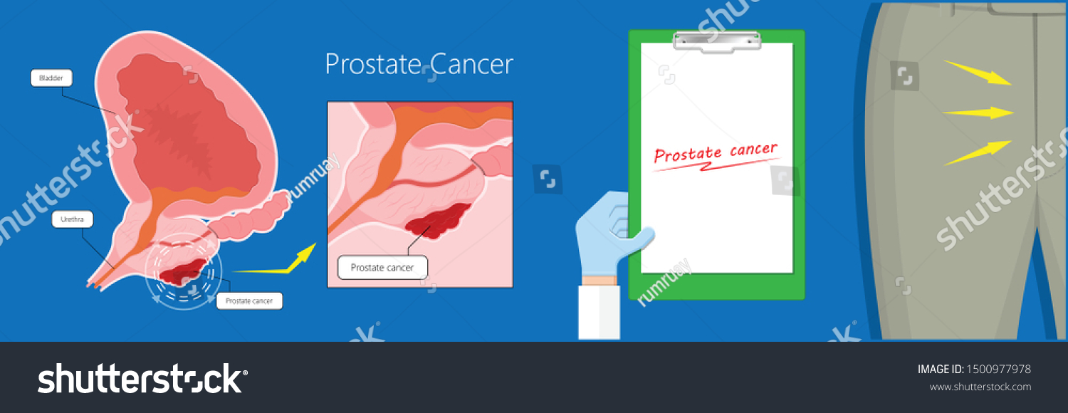 Transurethral Resection Prostate Stricture Urine Bladder Stock Vector Royalty Free 1500977978 4882