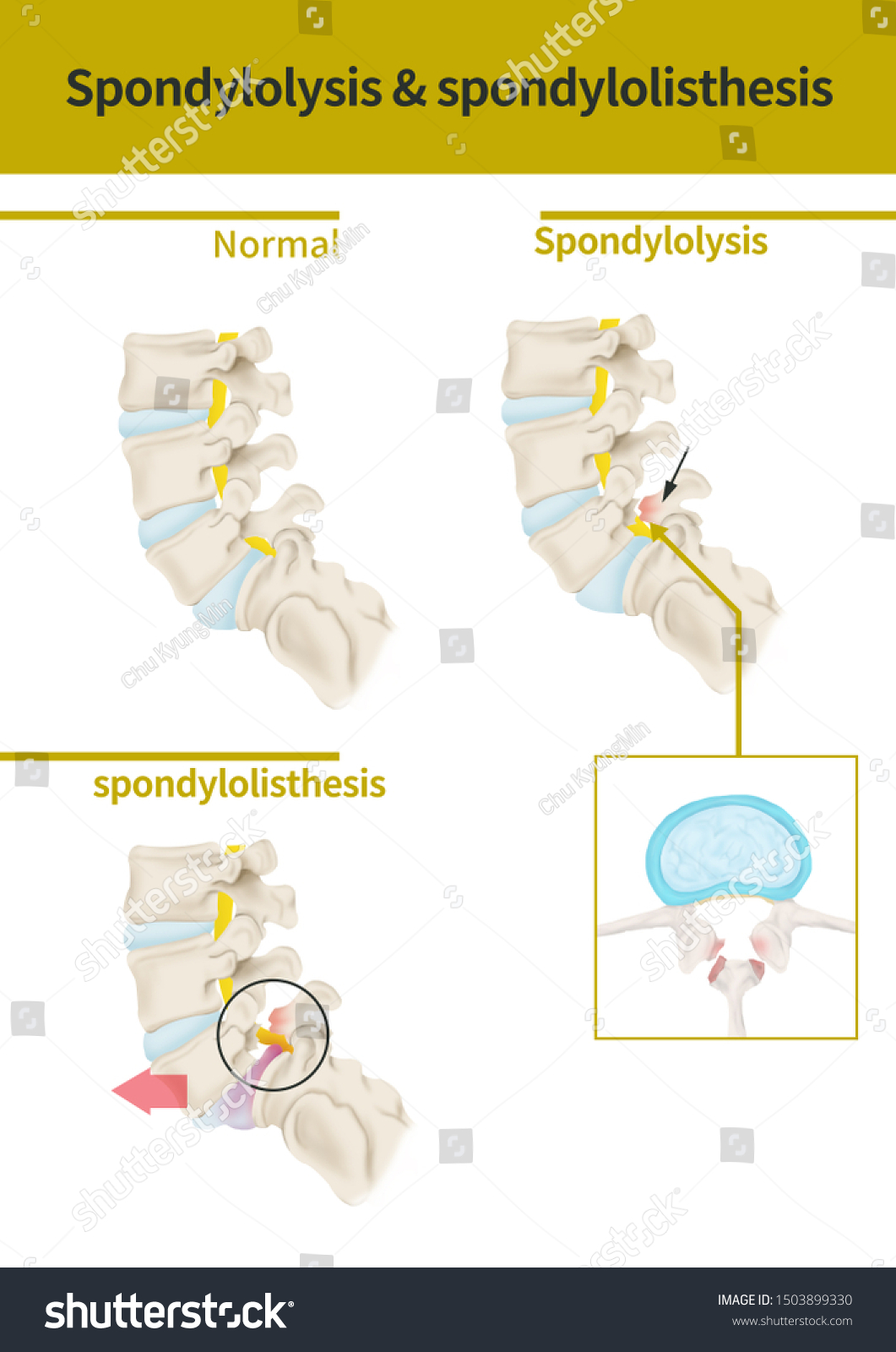 Medical Illustration Explain Spondylolysis Spondylolisthesis Stock ...