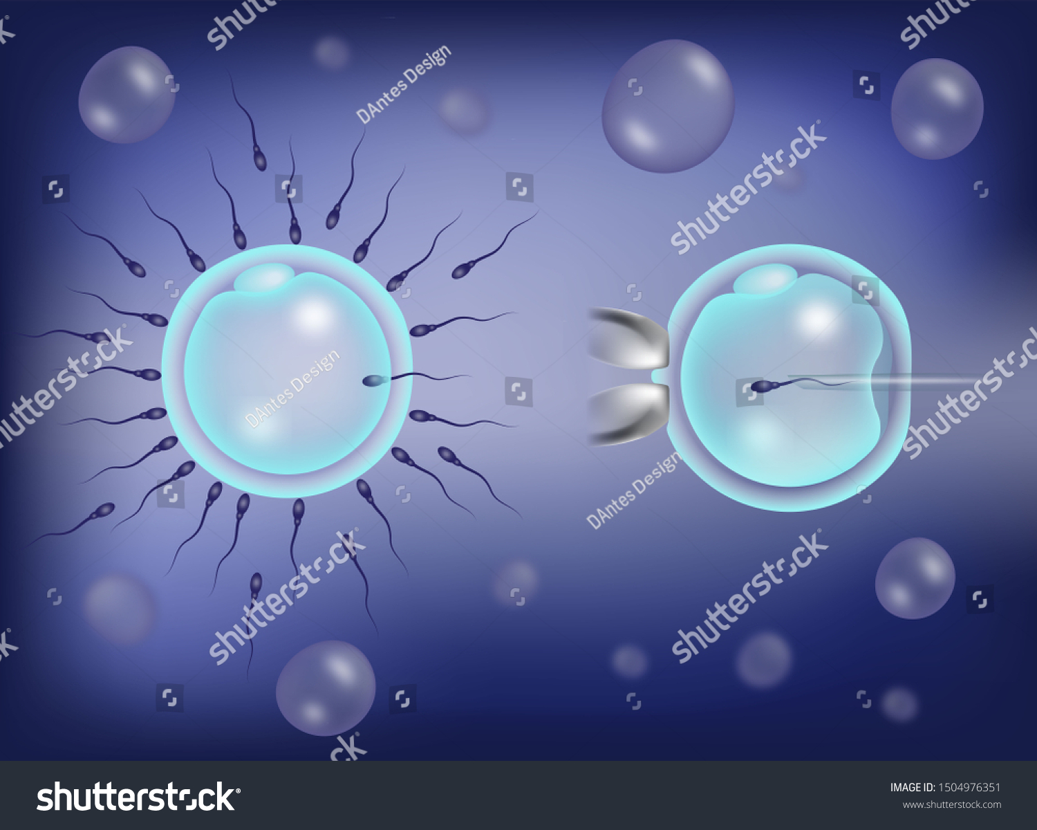 Intracytoplasmic Sperm Injection Icsi Process Versus Stock Illustration ...