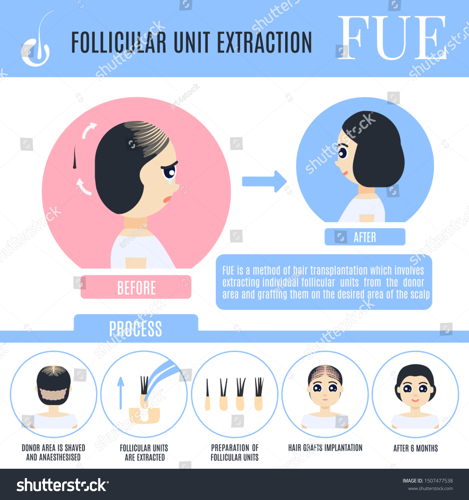 Follicular Unit Extraction Female Hair Loss Stock Illustration ...