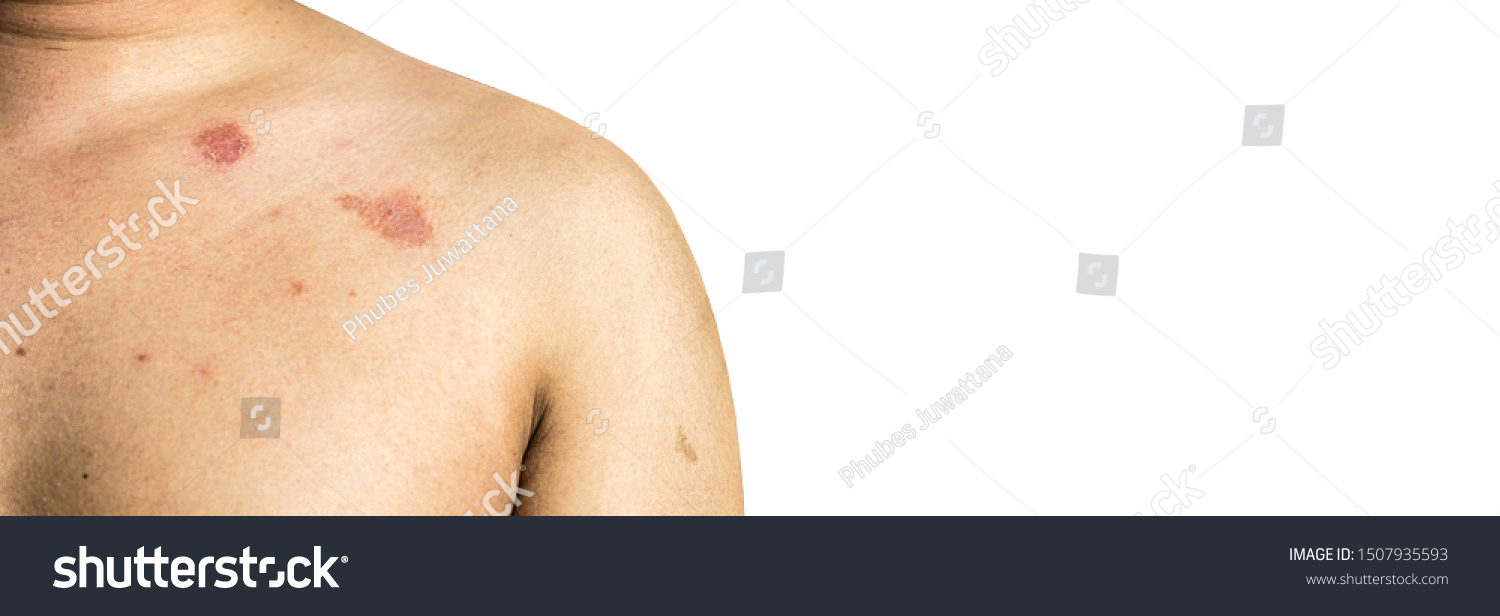 Ringworm On Body Caused By Fungus Stock Photo 1507935593 | Shutterstock