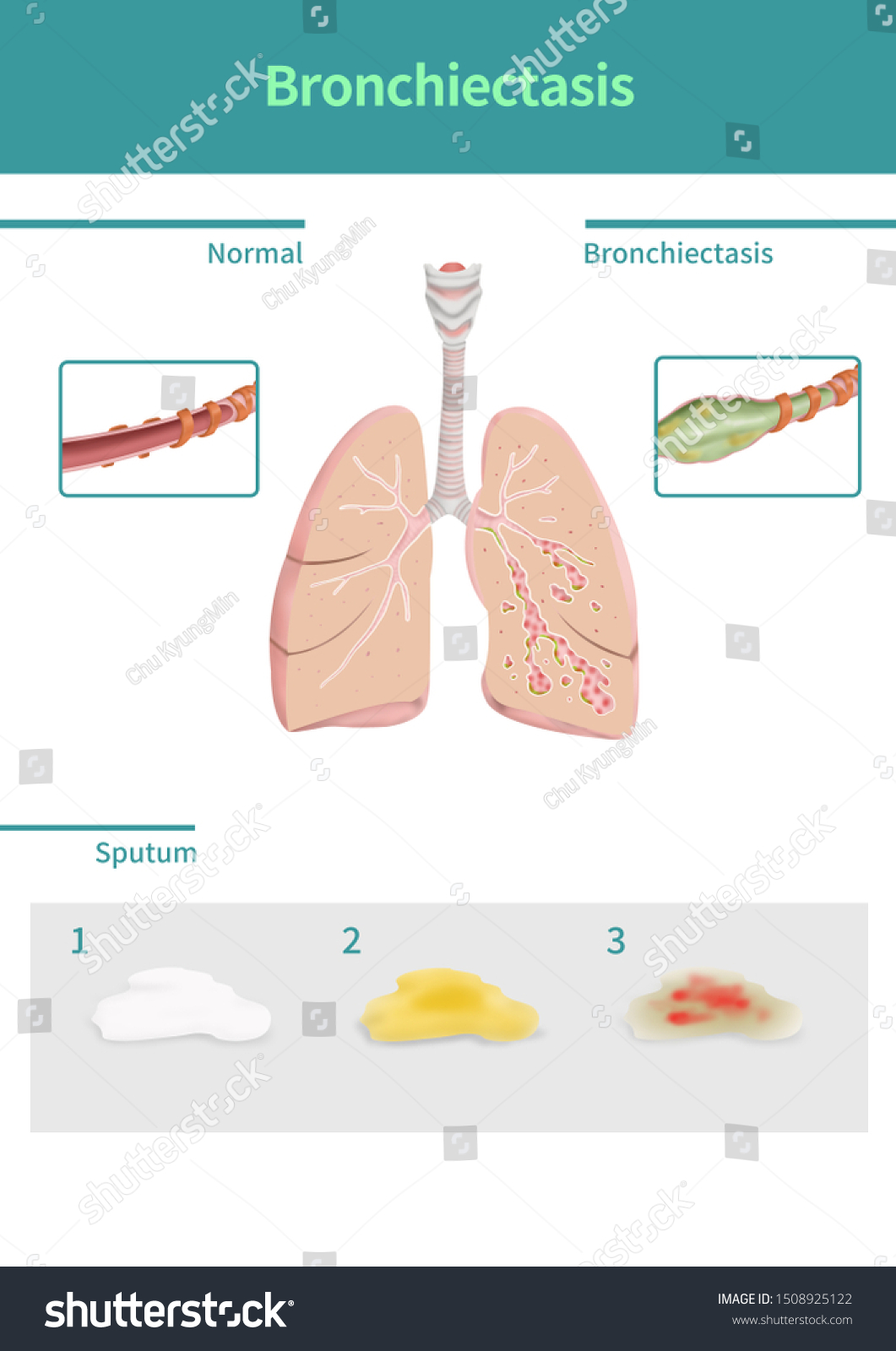 Medical Illustration Explain Bronchiectasis Stock Illustration ...