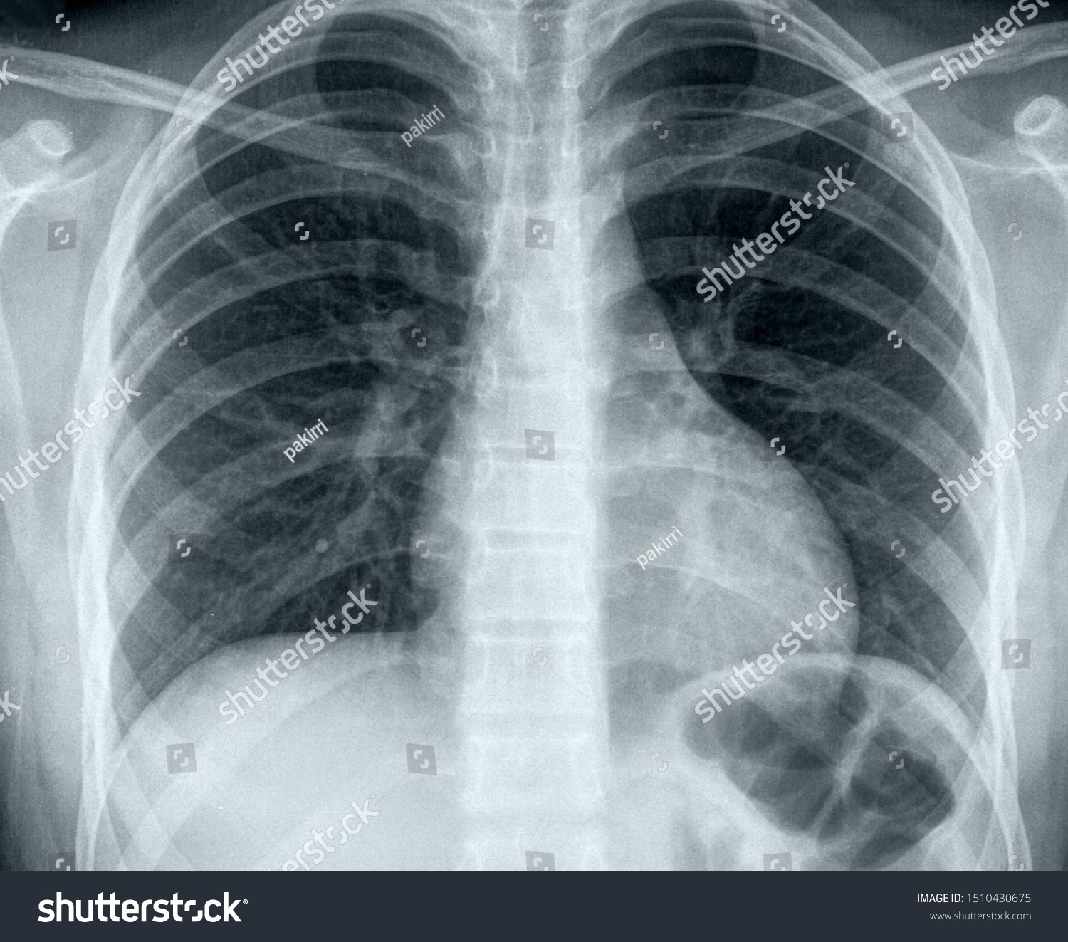 Chest X Ray Complicated Pneumonia Stock Photo 1510430675 | Shutterstock