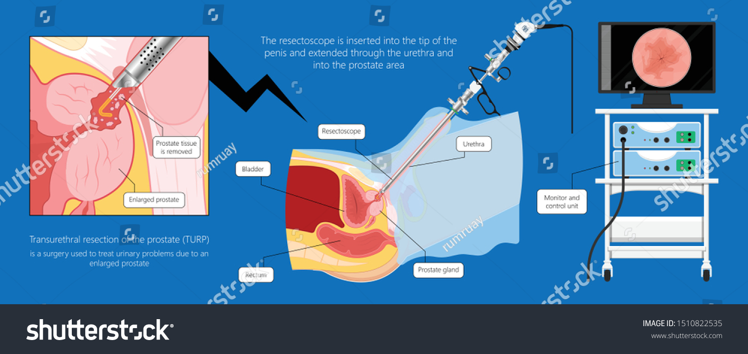 transurethral resection of the bladder