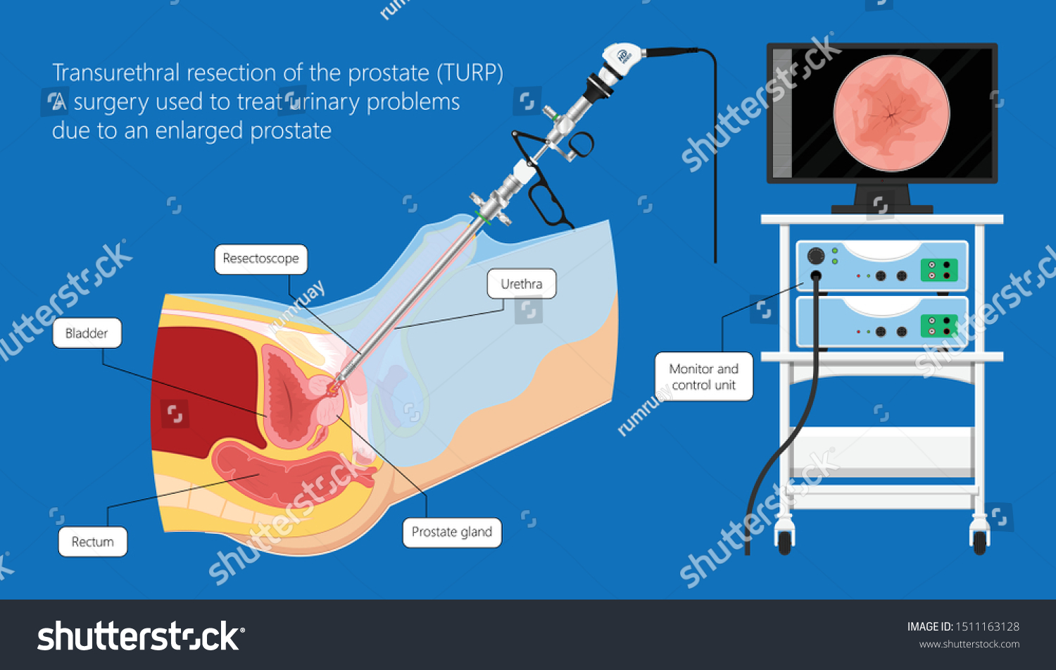 Transurethral Resection Of The Bladder