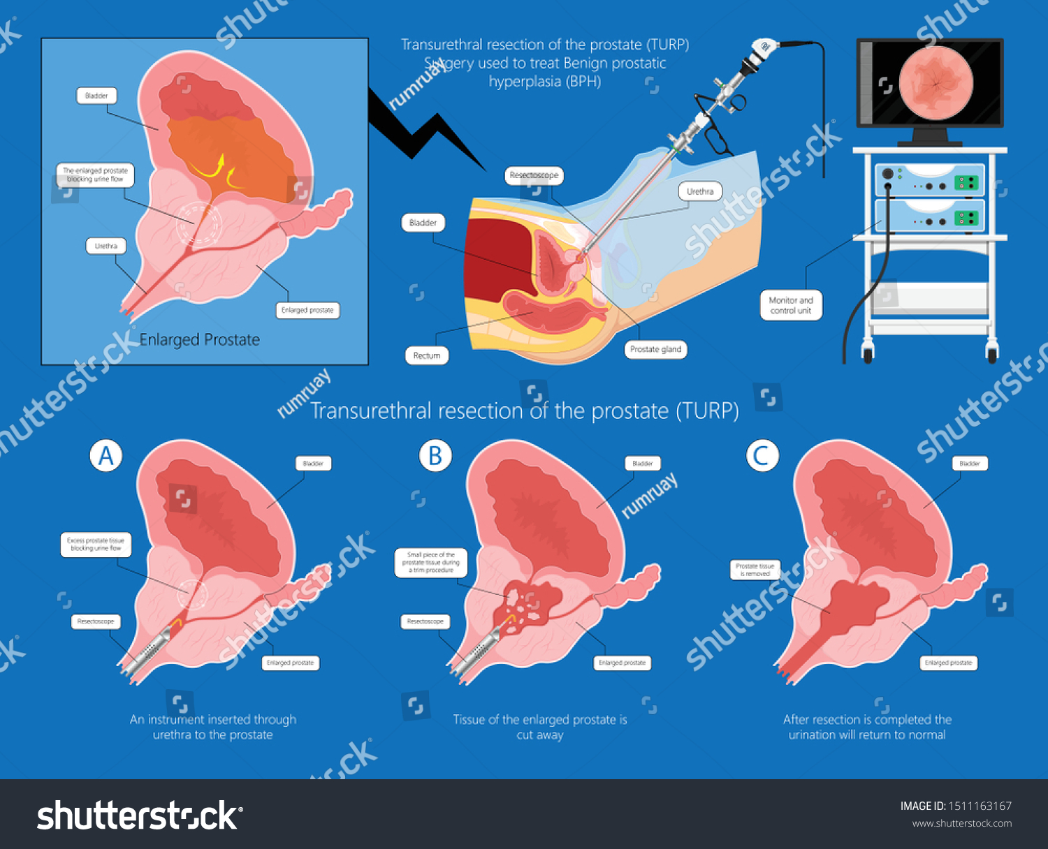 transurethral resection of the bladder