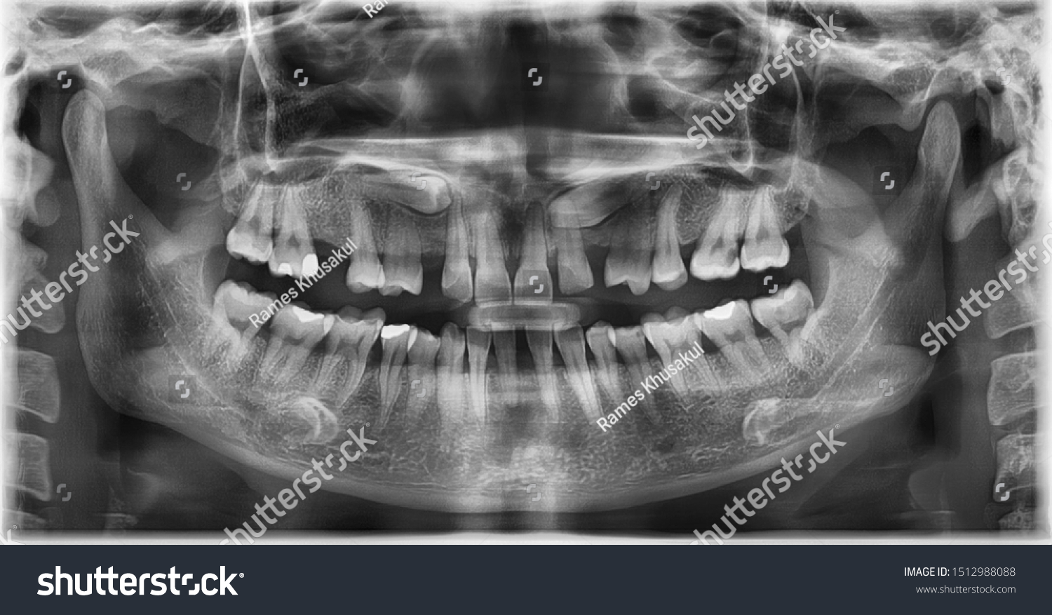 Panoramic Radiograph Showed Bilateral Embedded Canine Stock Photo ...