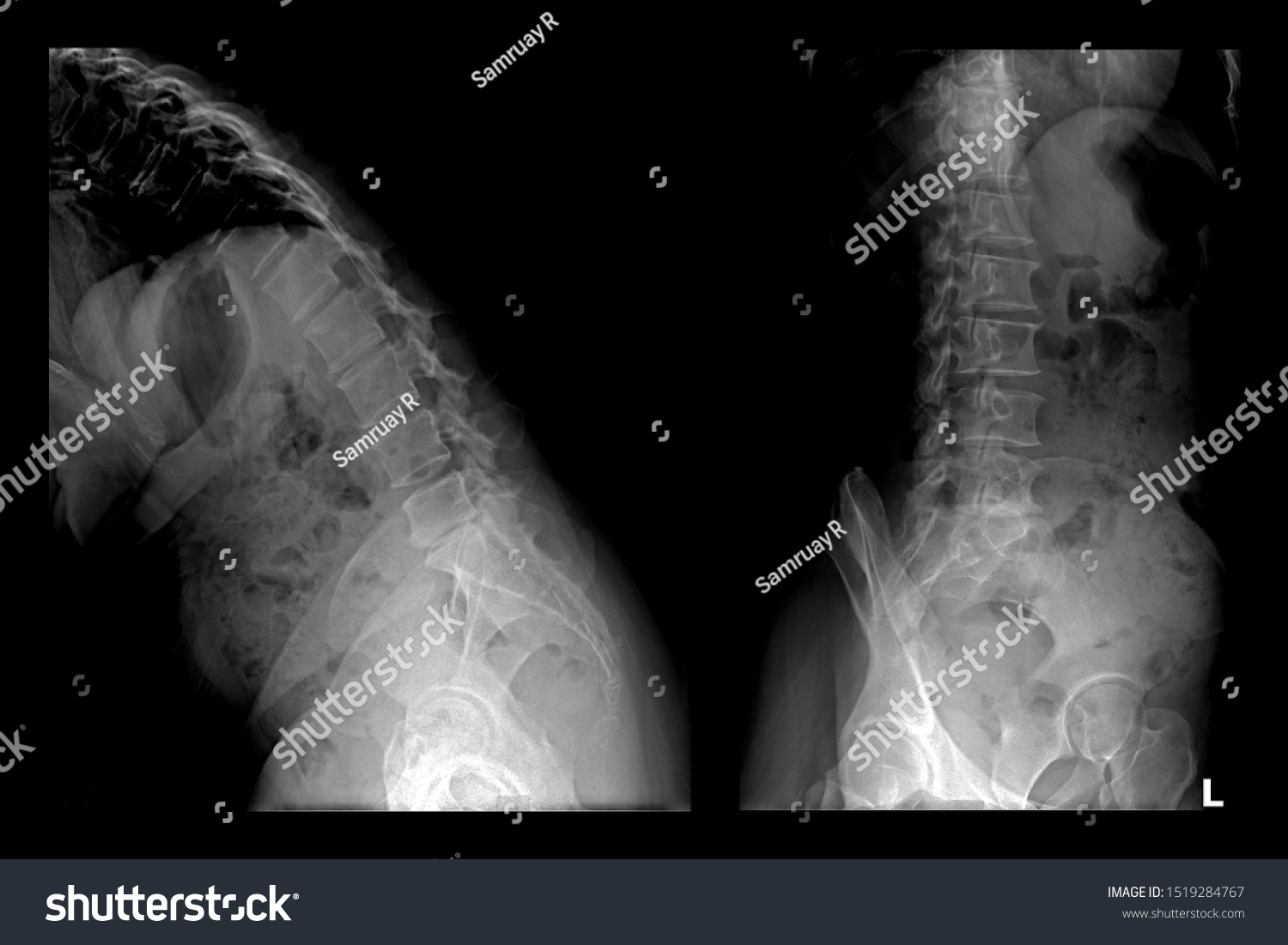 Two Xray Images Lumbar Spinelumbar Degenerative Stock Photo 1519284767 ...