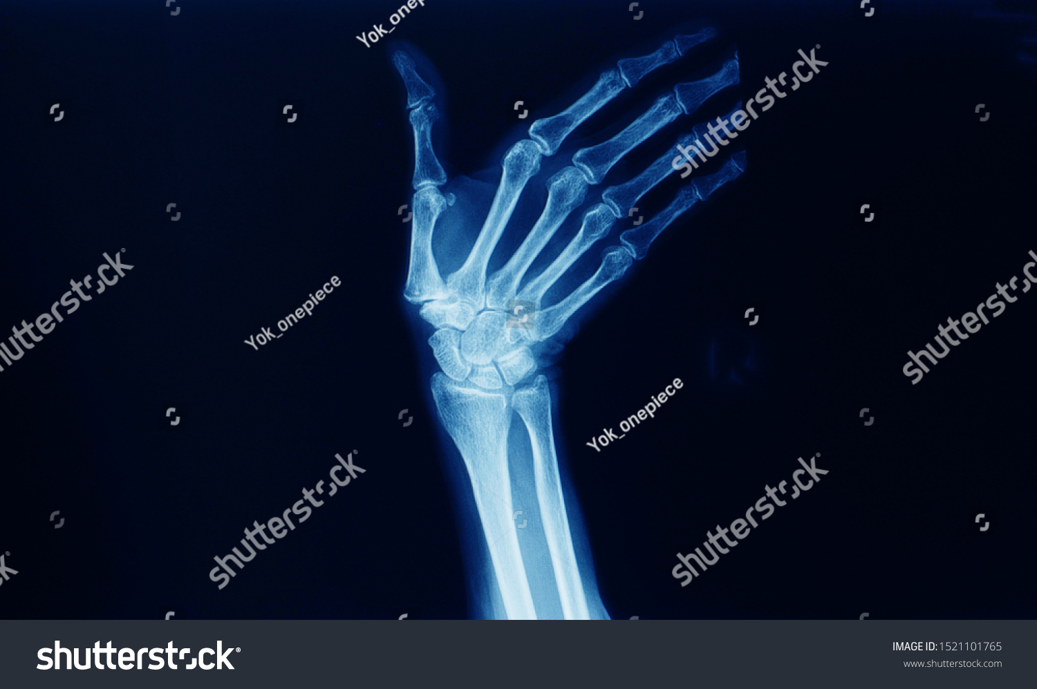 Xray Hand Wrist Joint Ulnar Position Stock Photo 1521101765 | Shutterstock