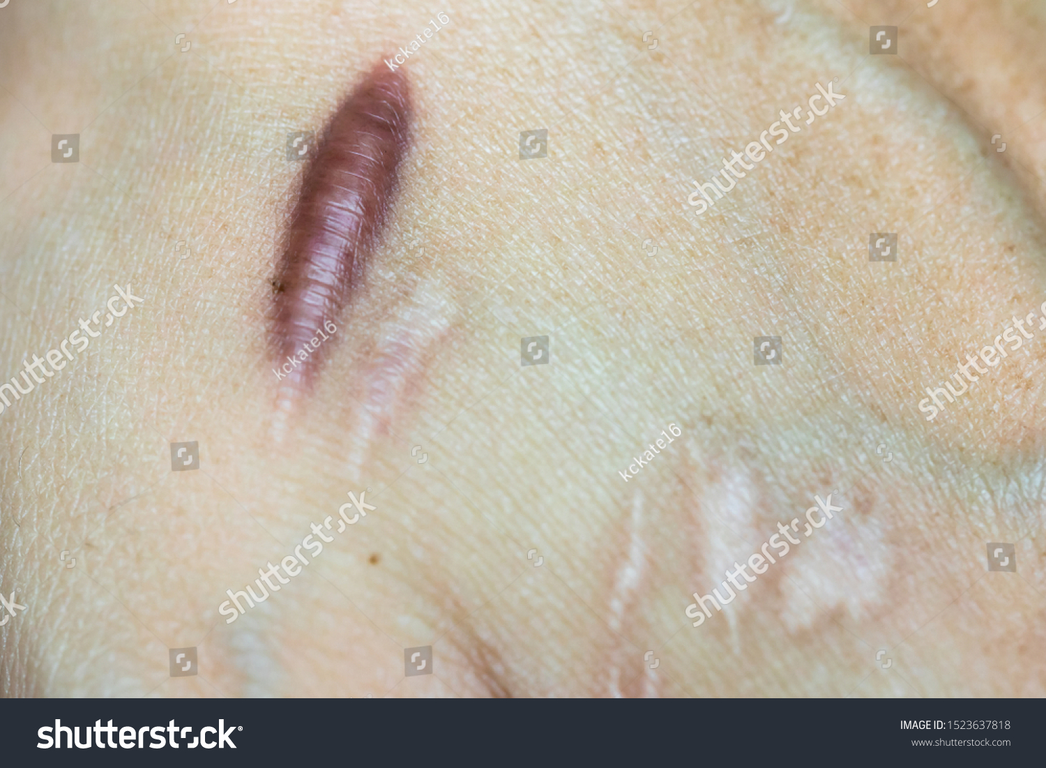 Keloid Scar Hypertrophic Scar On Man Stock Photo 1523637818 | Shutterstock