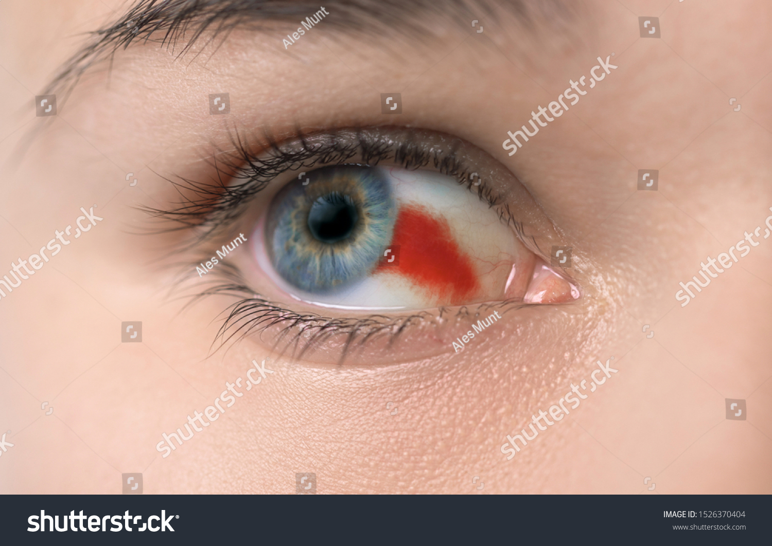 Young Woman Burst Blood Vessel Eye Stock Photo 1526370404 Shutterstock