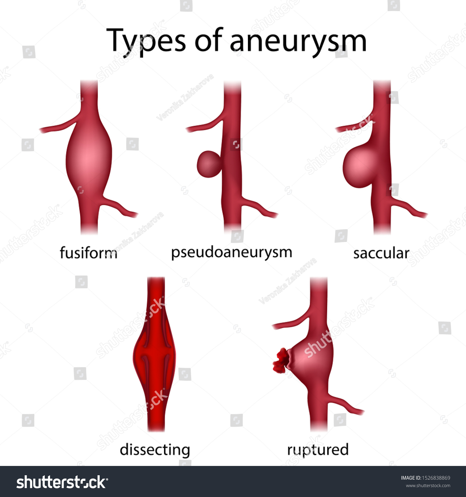 Types Aneurysm Fusiform Pseudoaneurysm Saccular Dissecting ภาพประกอบสต็อก 1526838869 Shutterstock 2914