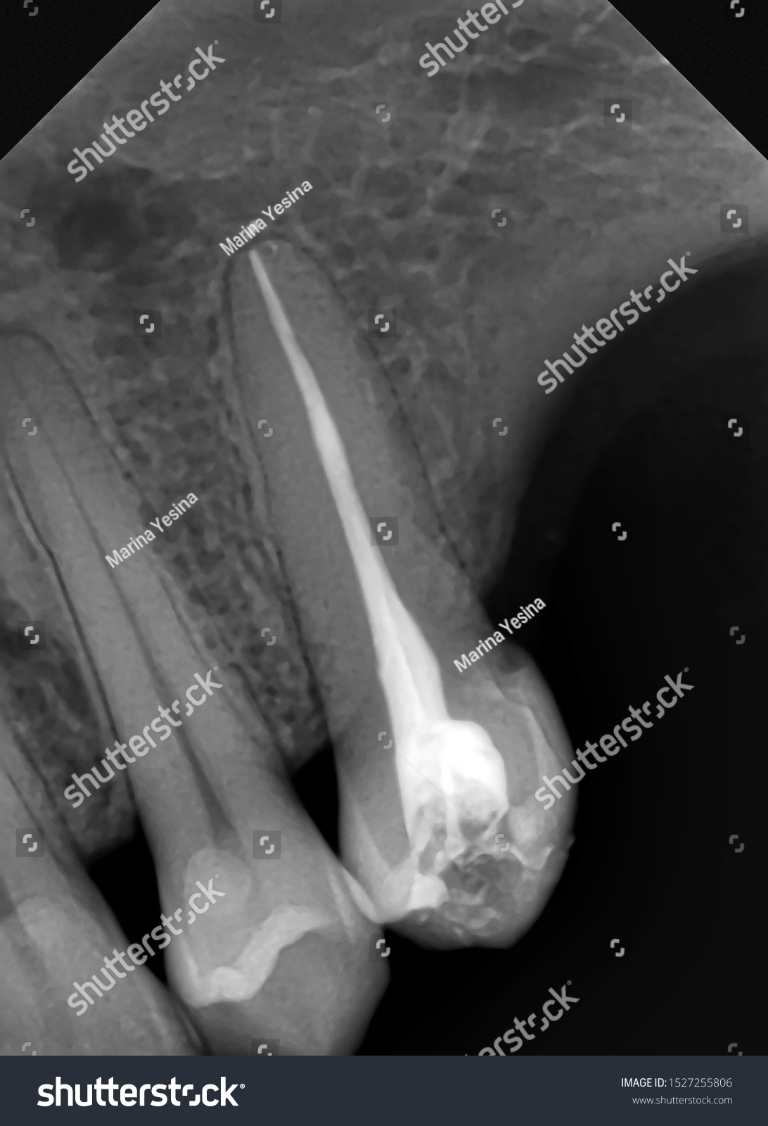 Good Treatment Tooth Xray Stock Photo 1527255806 | Shutterstock