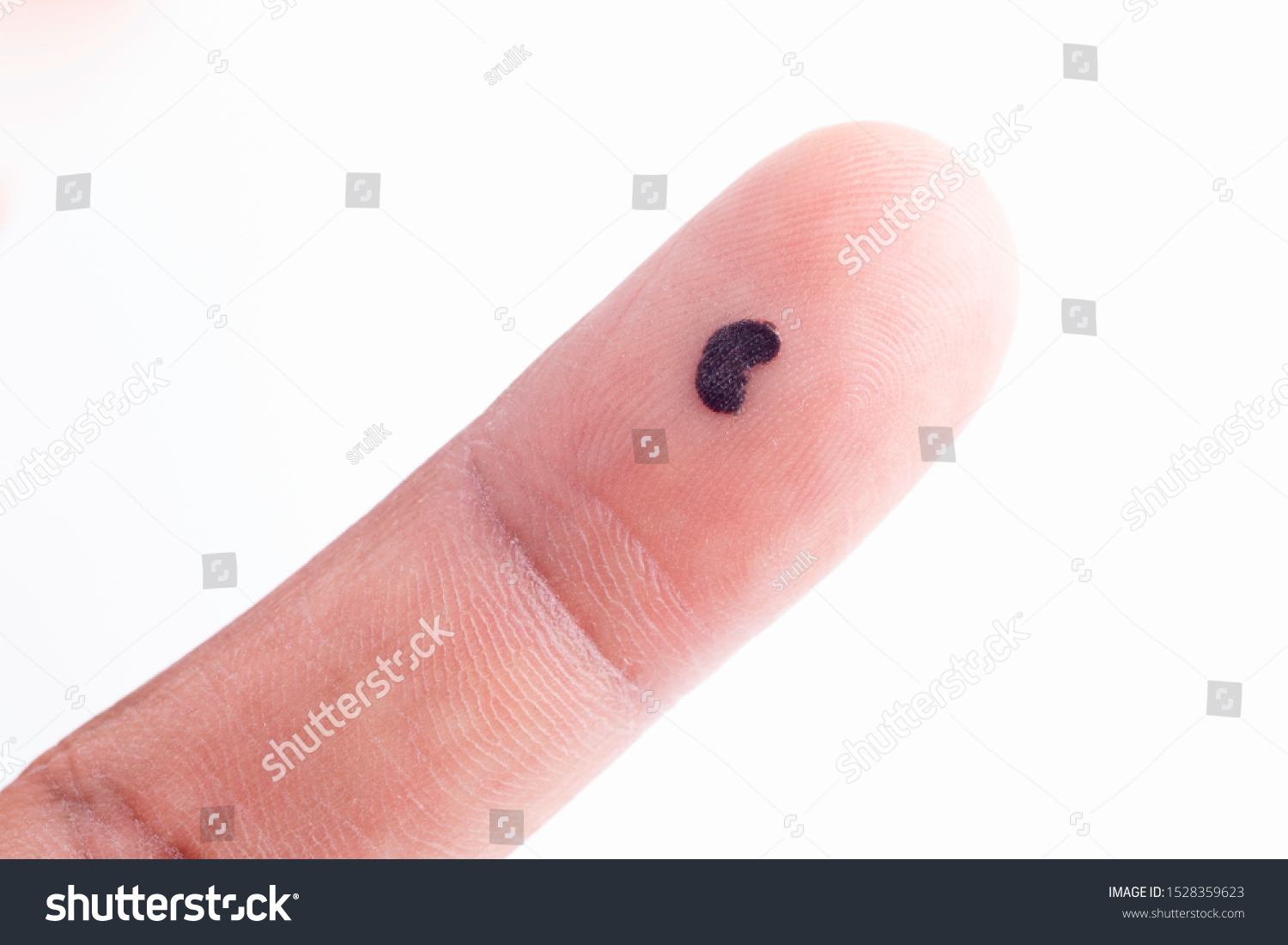 black-spot-on-finger-close-foto-de-stock-1528359623-shutterstock