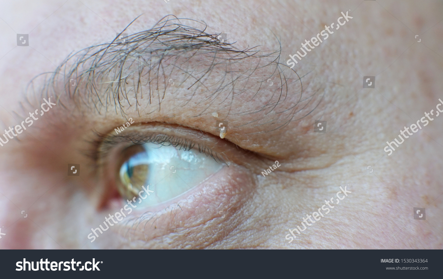 Viral Papilloma Skin Eyebrows Wart Removal Stock Photo 1530343364