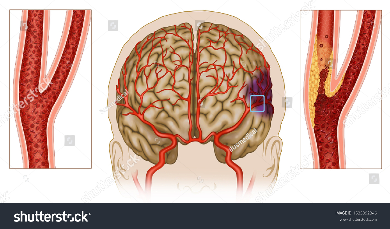 Причины сужения сосудов головного. Ангиодистония церебральных сосудов. Ангиодистония артерий головного мозга. Стеноз артерий головного мозга. Ангиодистония позвоночных артерий.