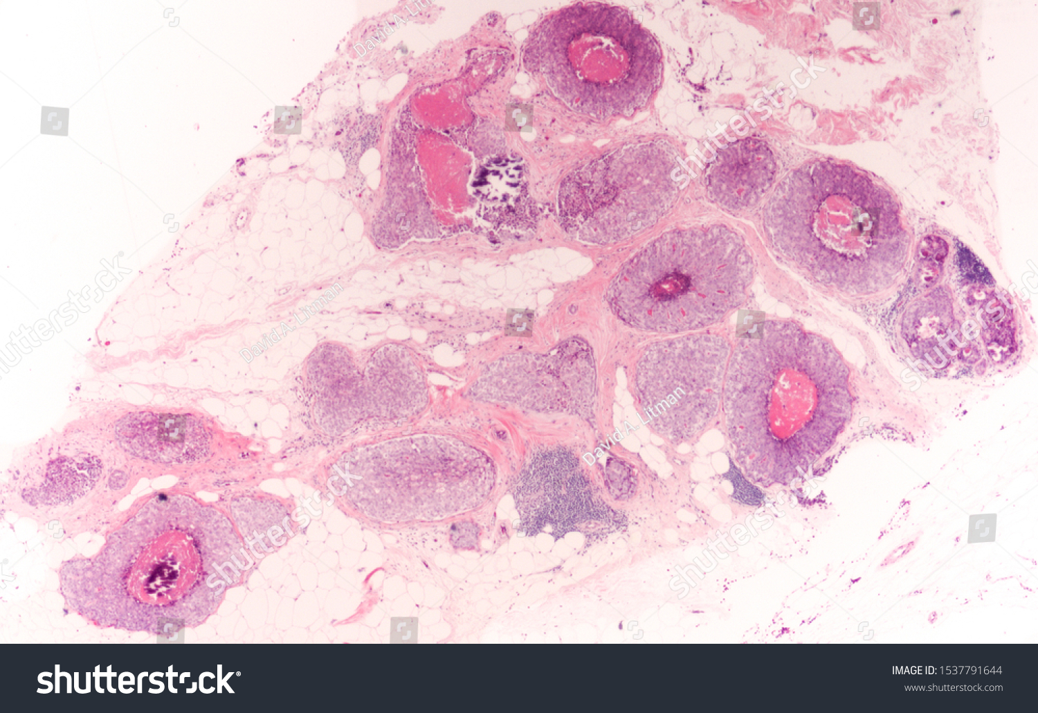 breast-biopsy-ductal-carcinoma-situ-dcis-stock-photo-1537791644