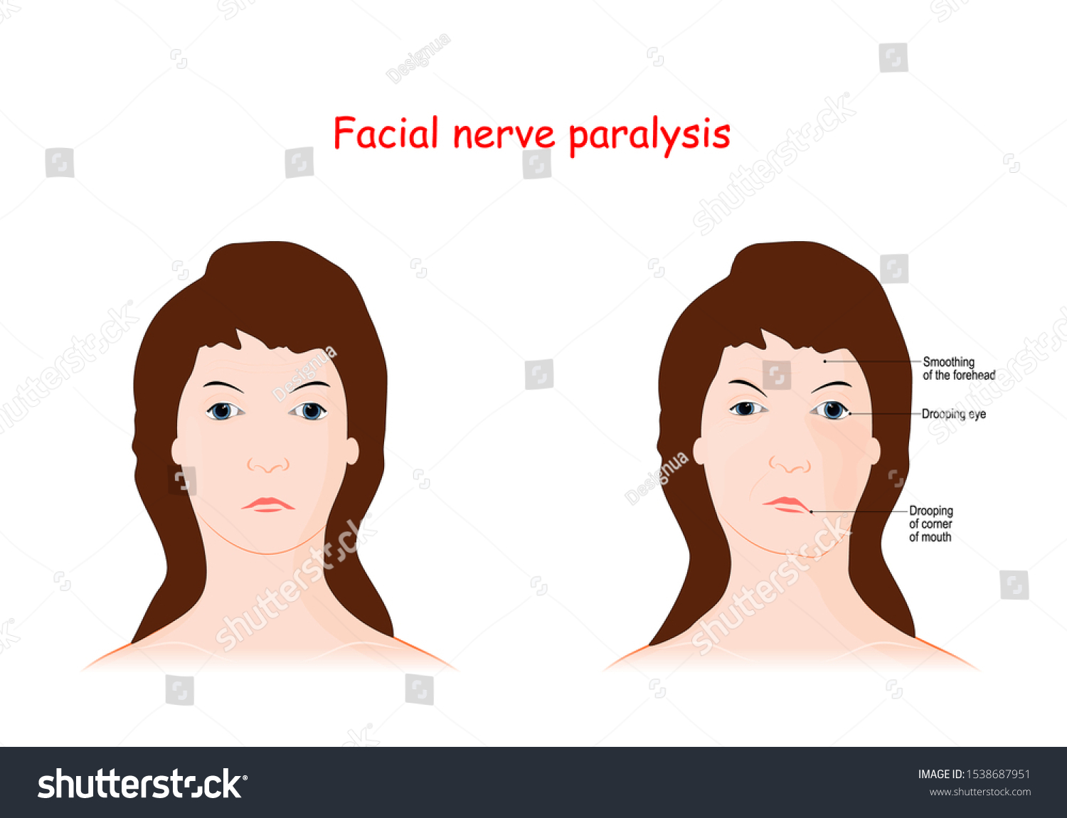 Facial Nerve Paralysis Therapy Reanimation Surgery Stock Vector ...