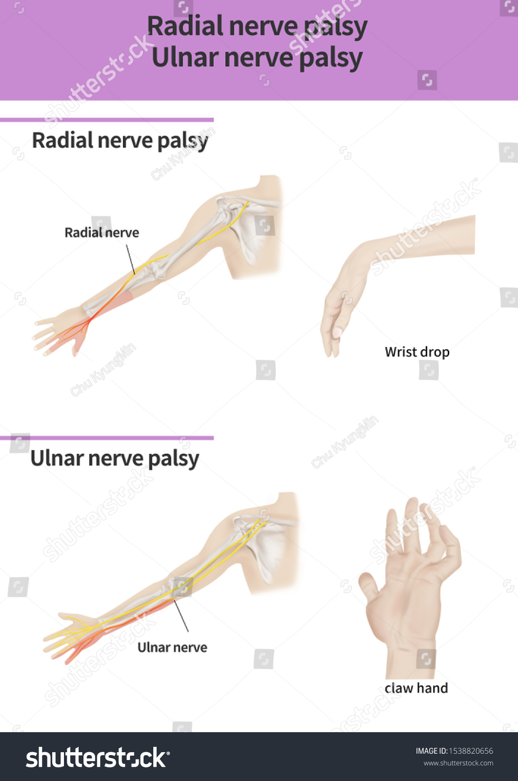 Radial Nerve Palsy Symptoms