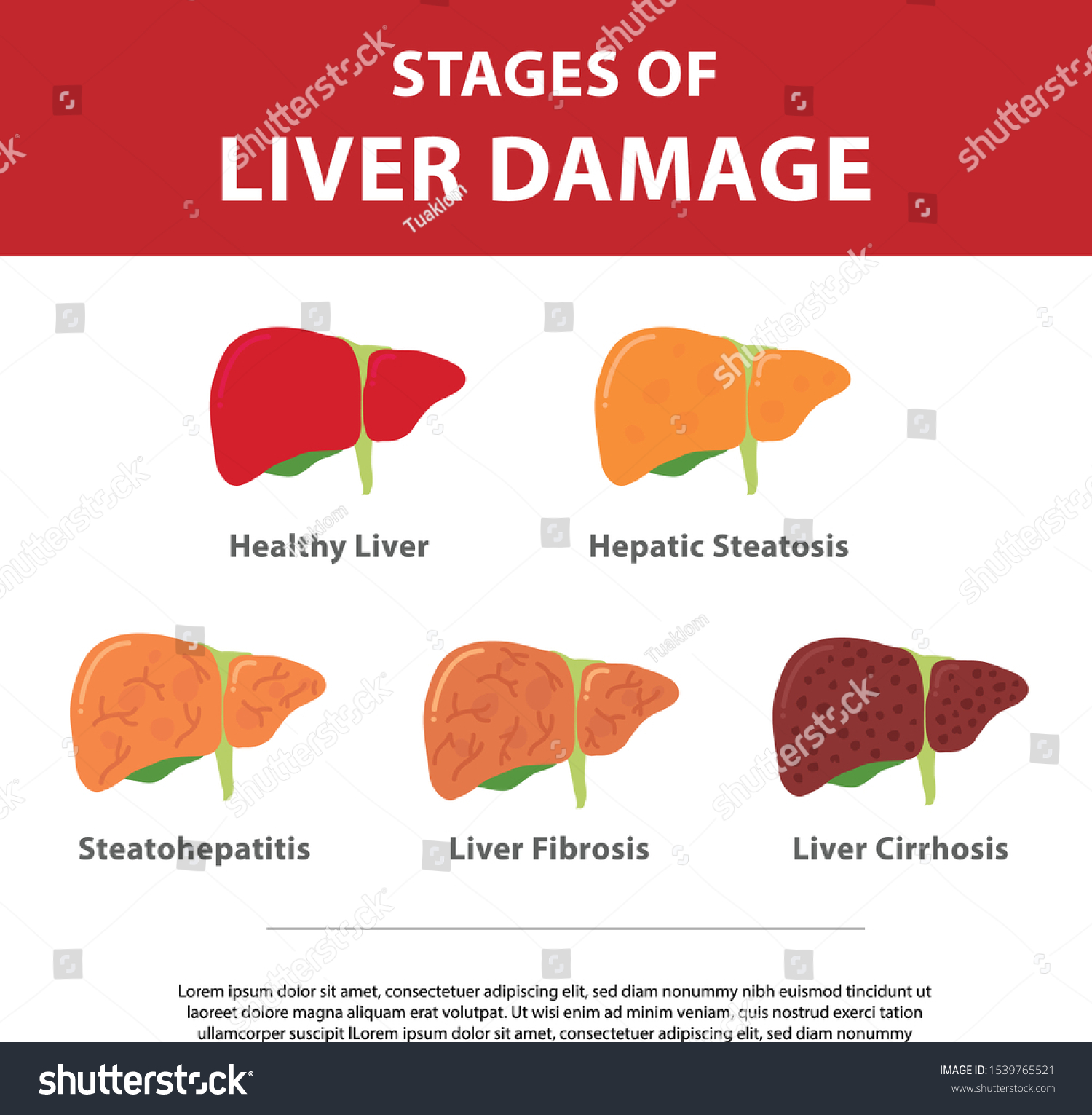 Stages Liver Damage Concept Vector Illustration Stock Vector (Royalty ...