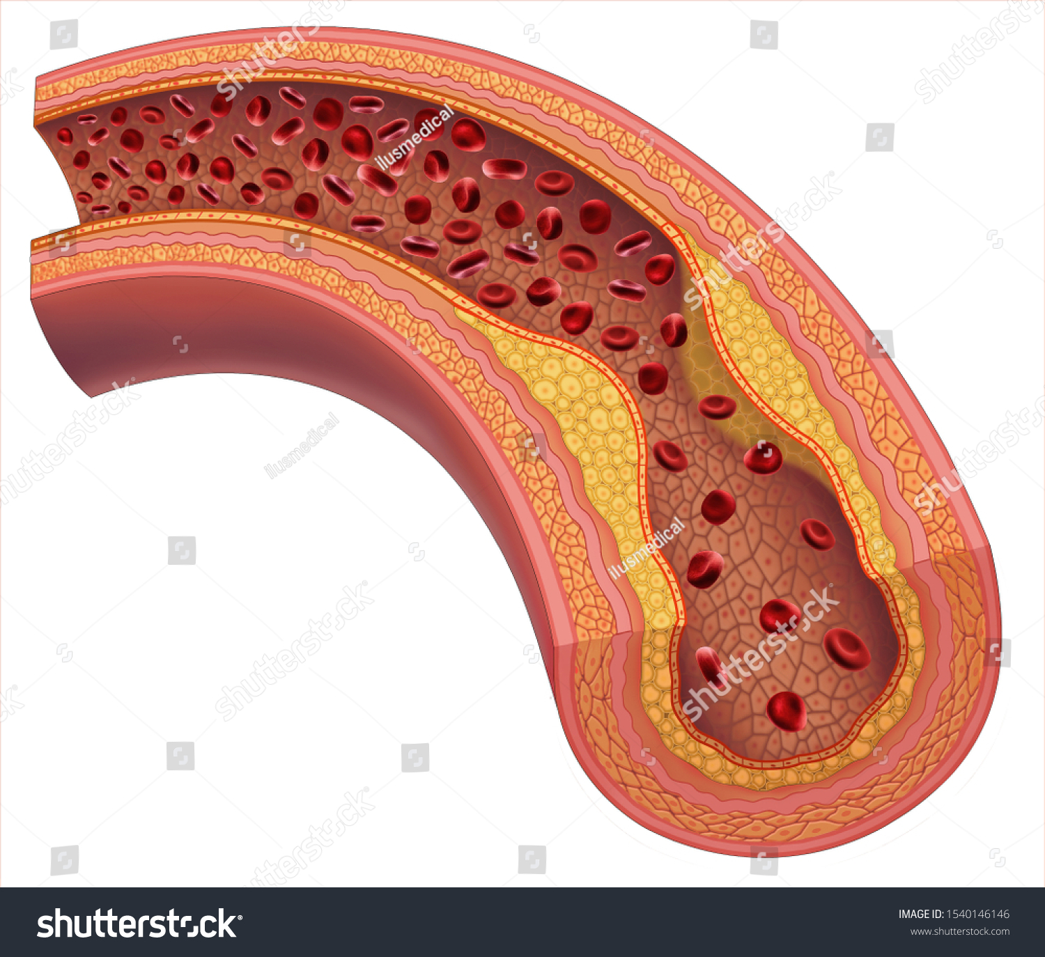 Atherosclerosis Arterial Disease Caused By Excessive Stock Illustration ...