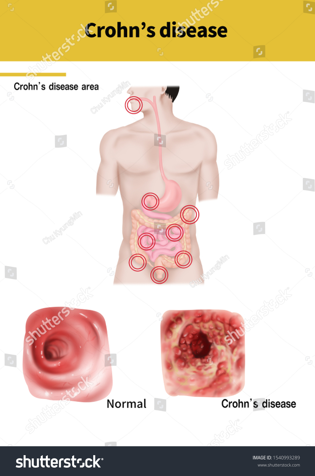 medical-illustration-explain-disease-stock-illustration-1540993289