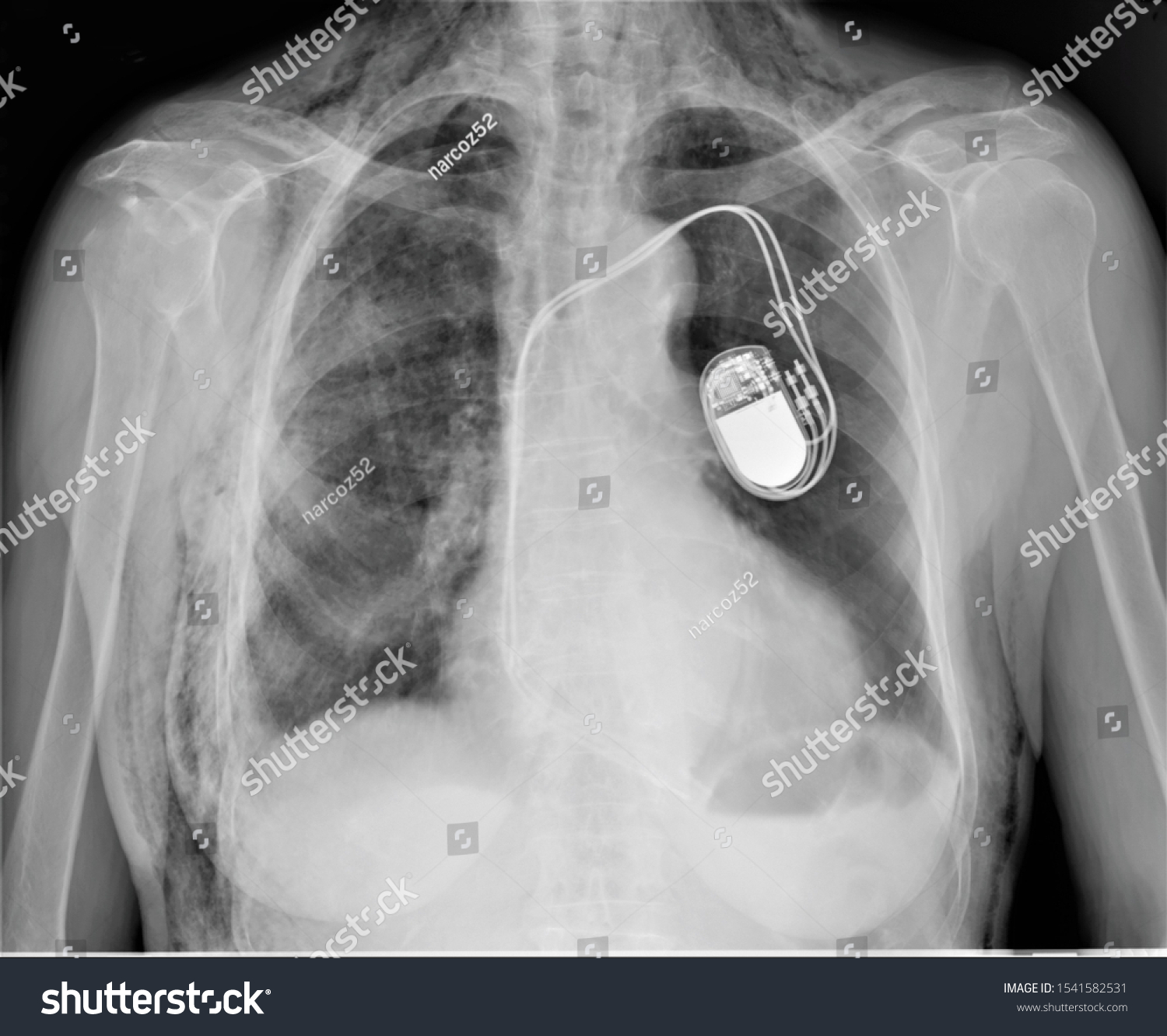 Panoramic Radiograph Chest Implanted Cardiac Pacemakermedical Stock ...