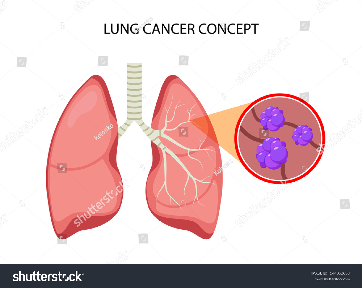 Lung Cancer Vector Concept Repiratory Disease Stock Vector (Royalty ...