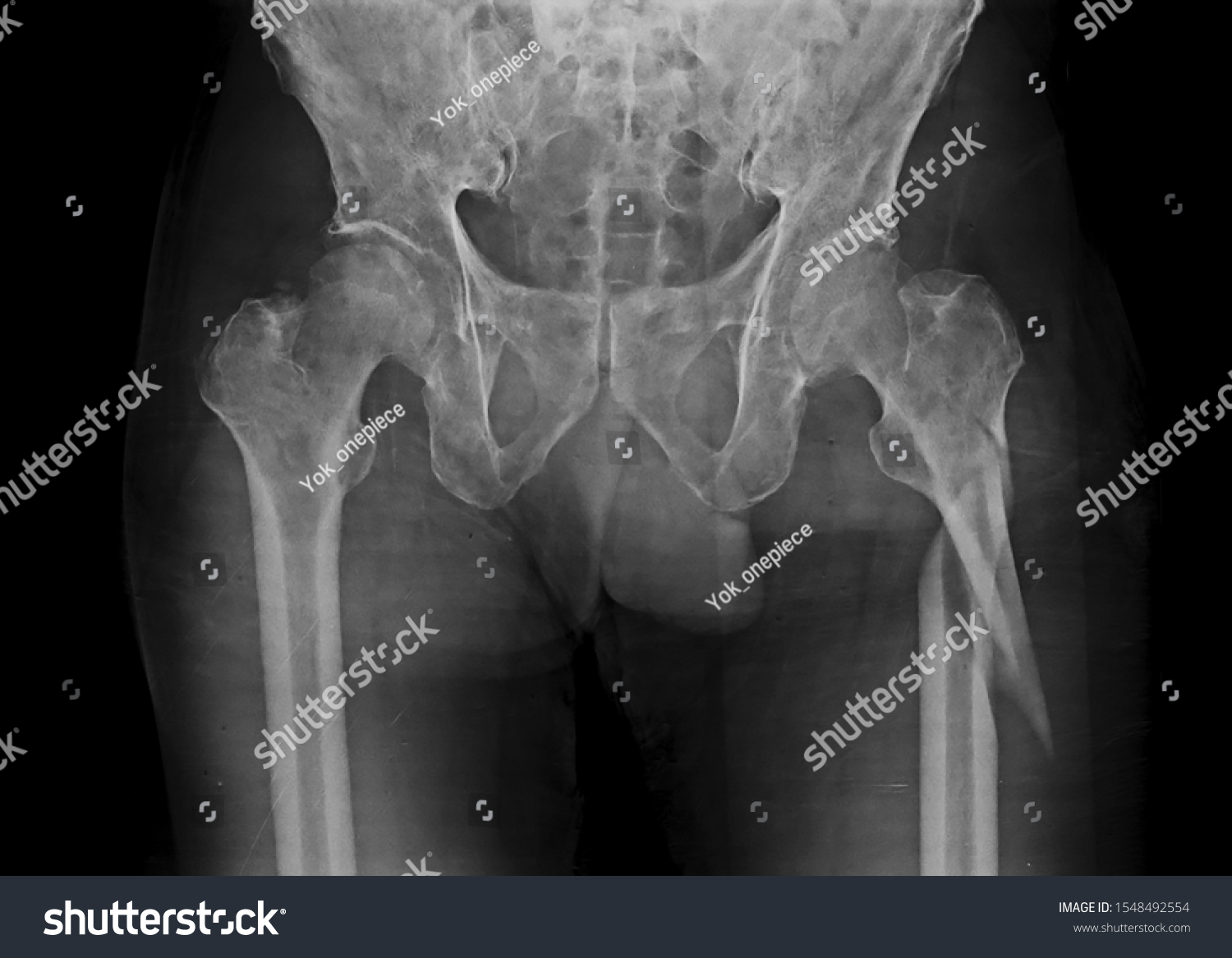 hip xray normal vs fracture