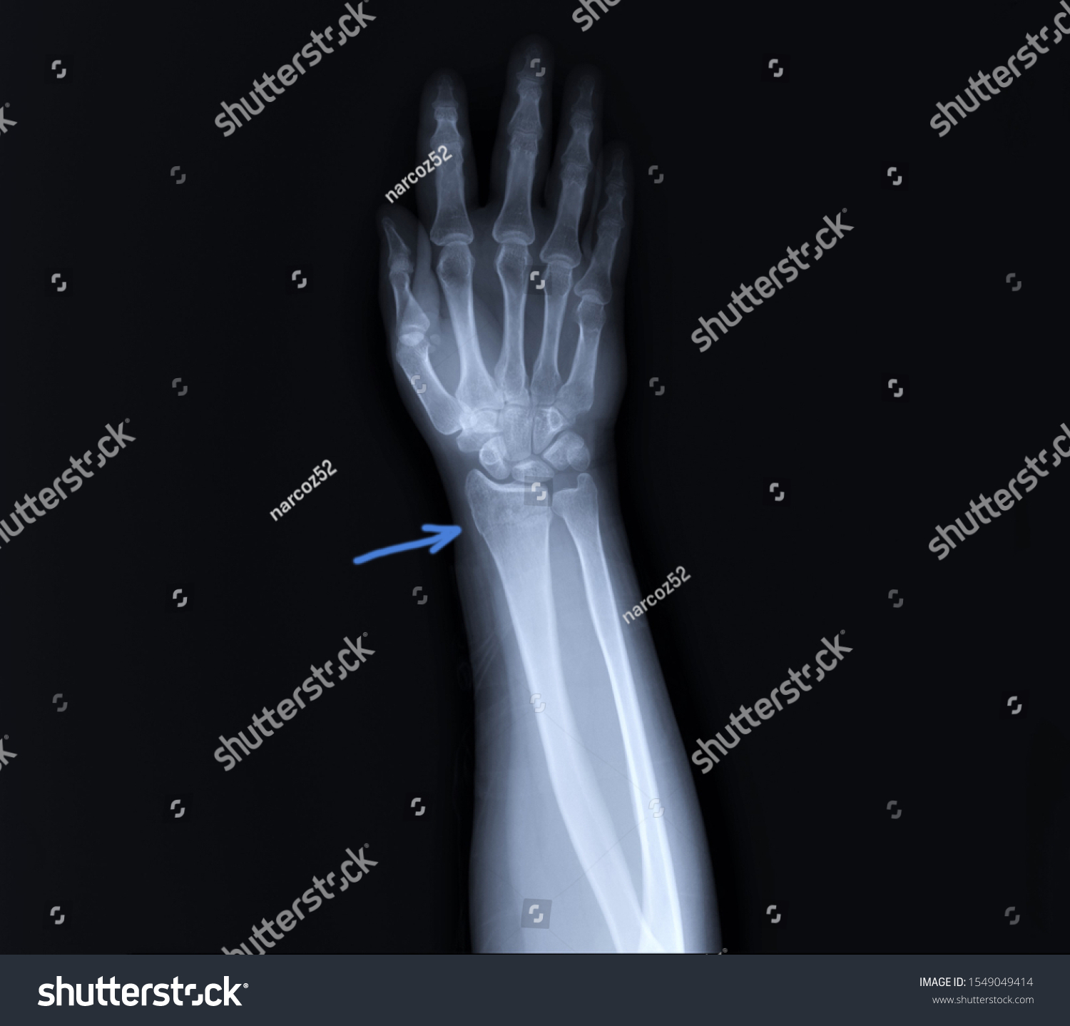 Radiograph Forearm Bones Fracture Radius Stock Photo 1549049414 ...