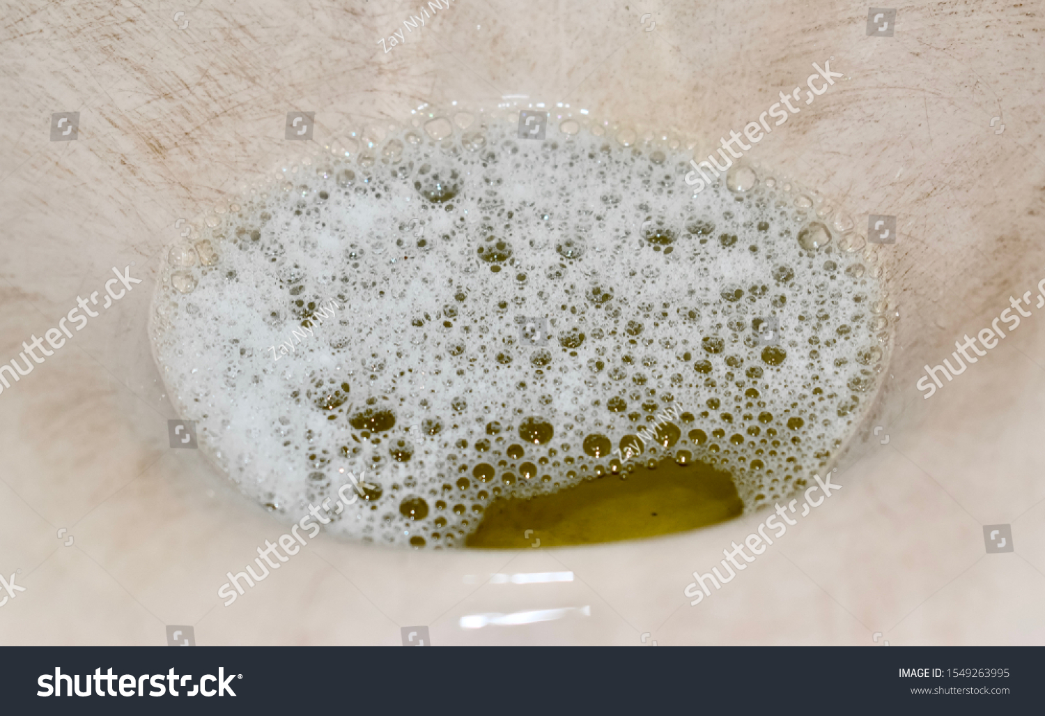 Foamy urine : 17 images, photos et images vectorielles de stock ...