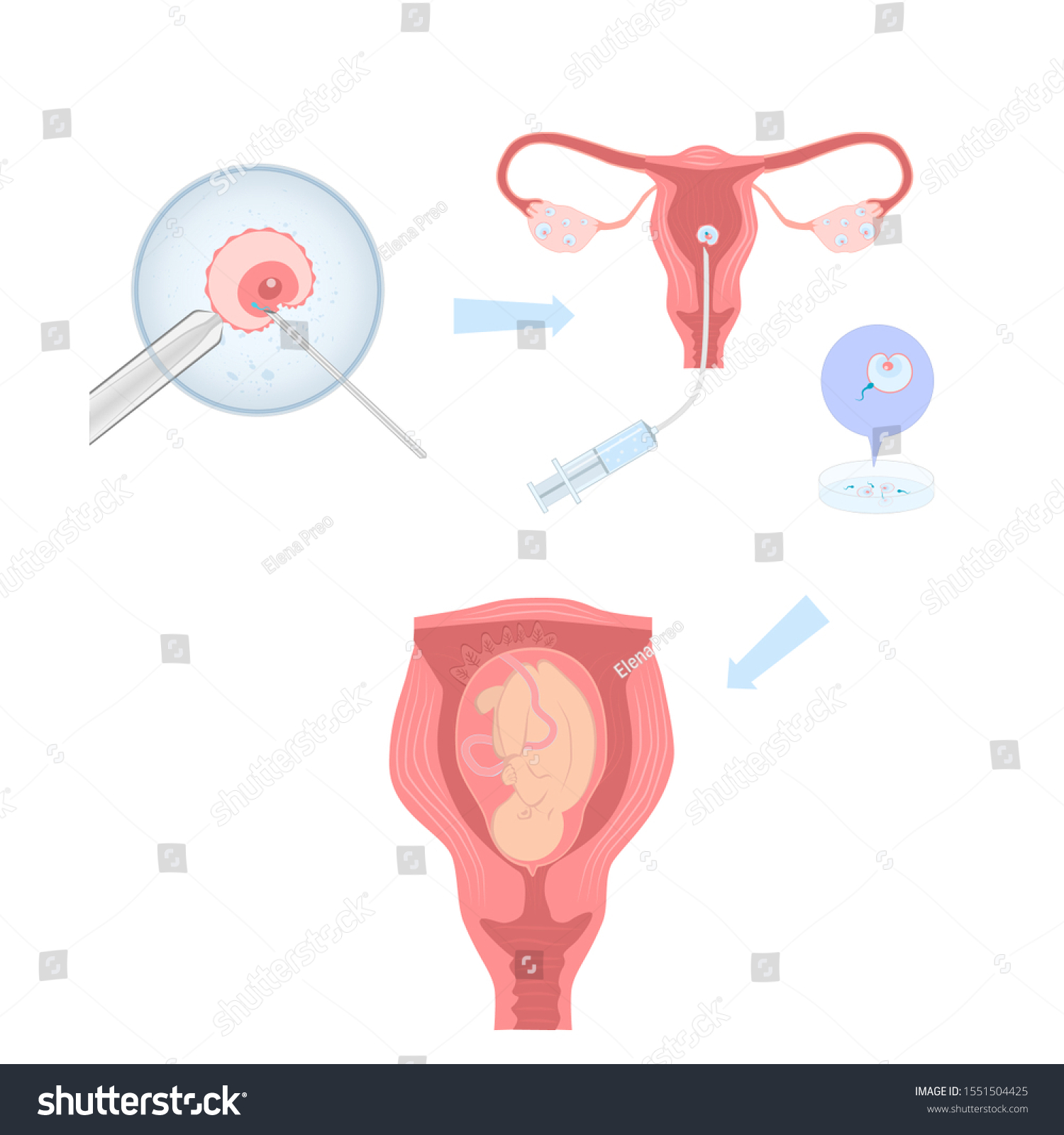 Artificial Insemination Illustration Process Infographics Stock Vector