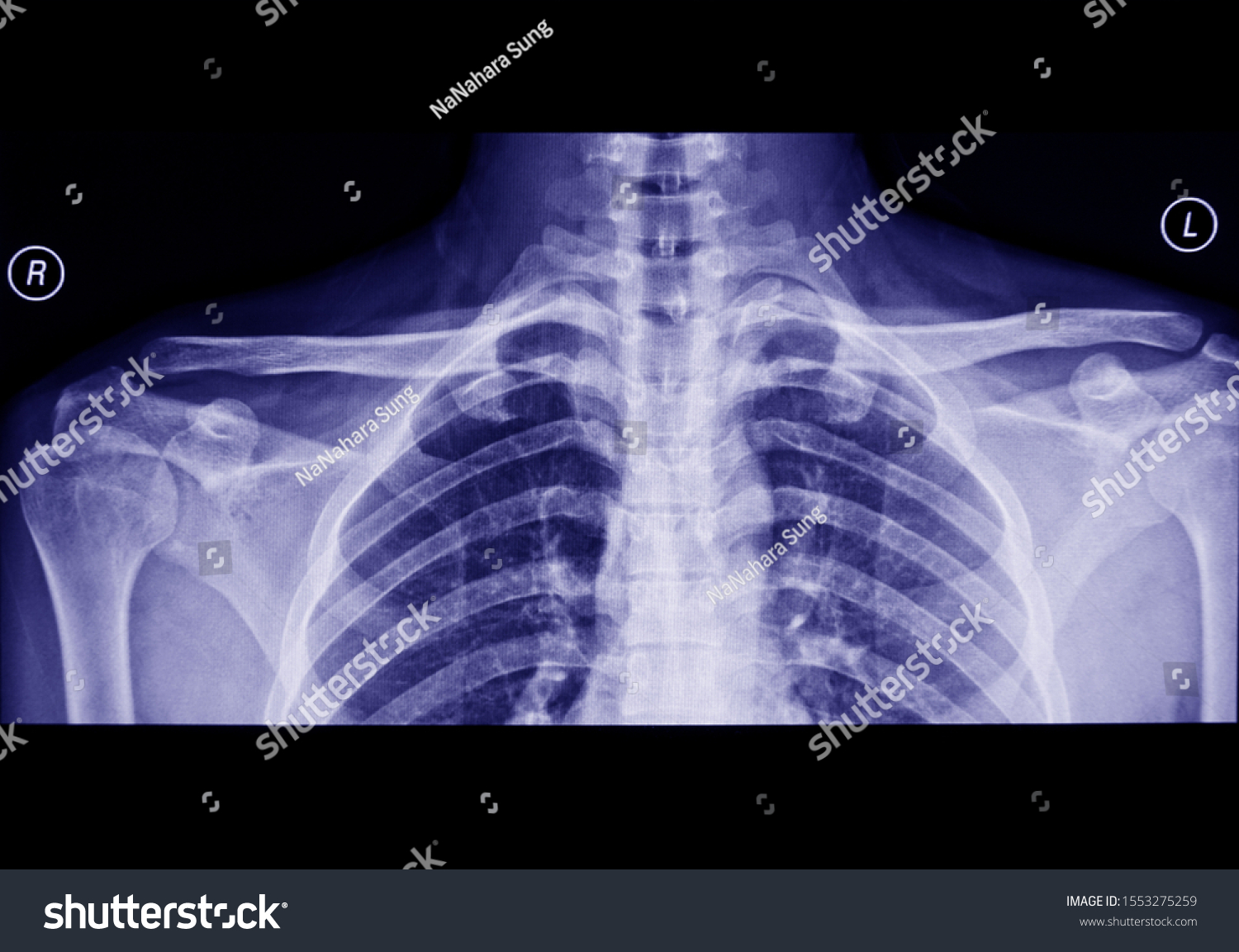 Xray Shoulder Joint Show Clavicle Stock Photo Shutterstock