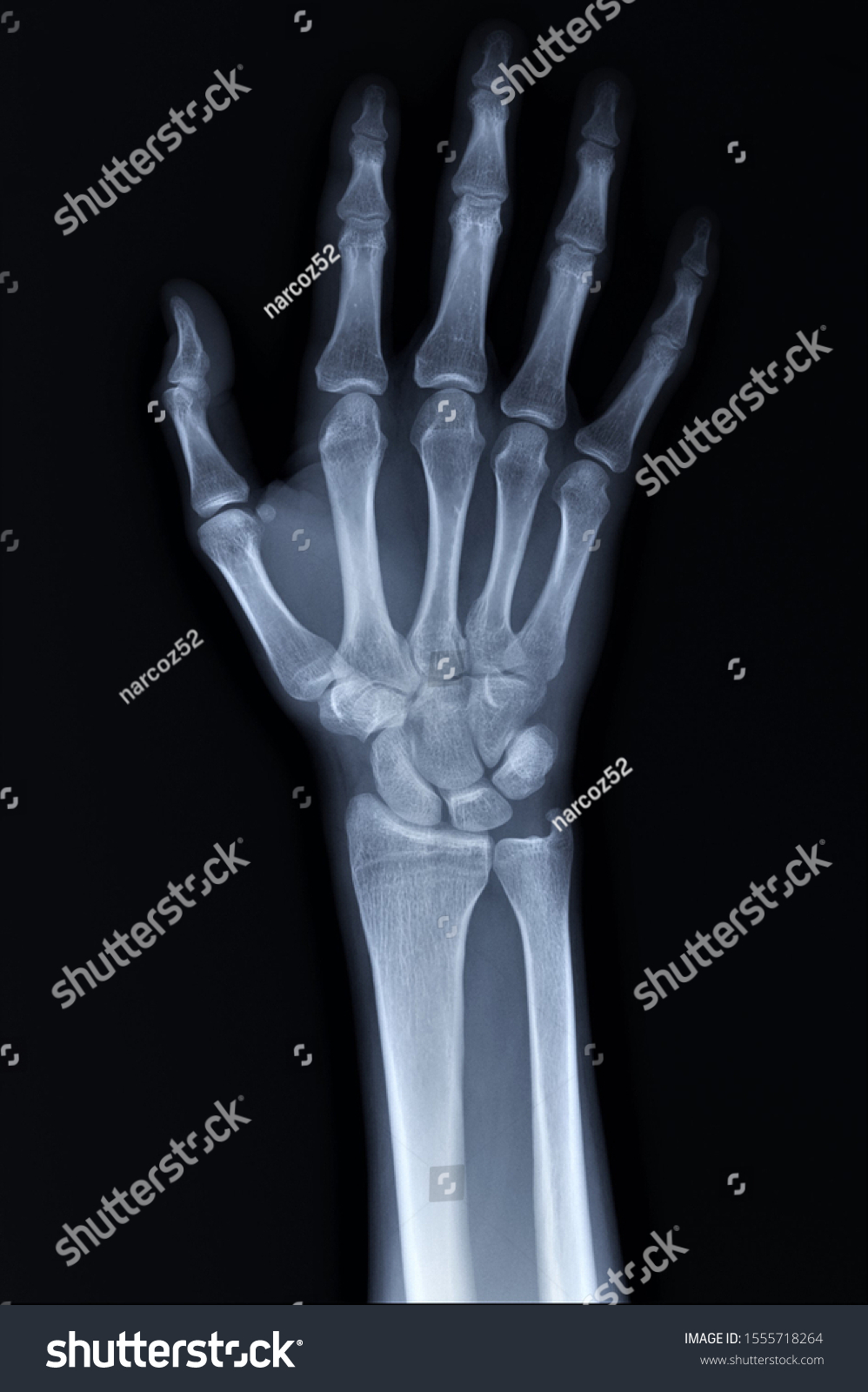 Normal Radiography Hand Wrist Bones Traumatology Stock Photo 1555718264 ...