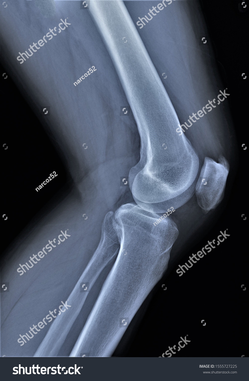 Normal Radiography Knee Joint Lateral Projection Stock Photo 1555727225 ...