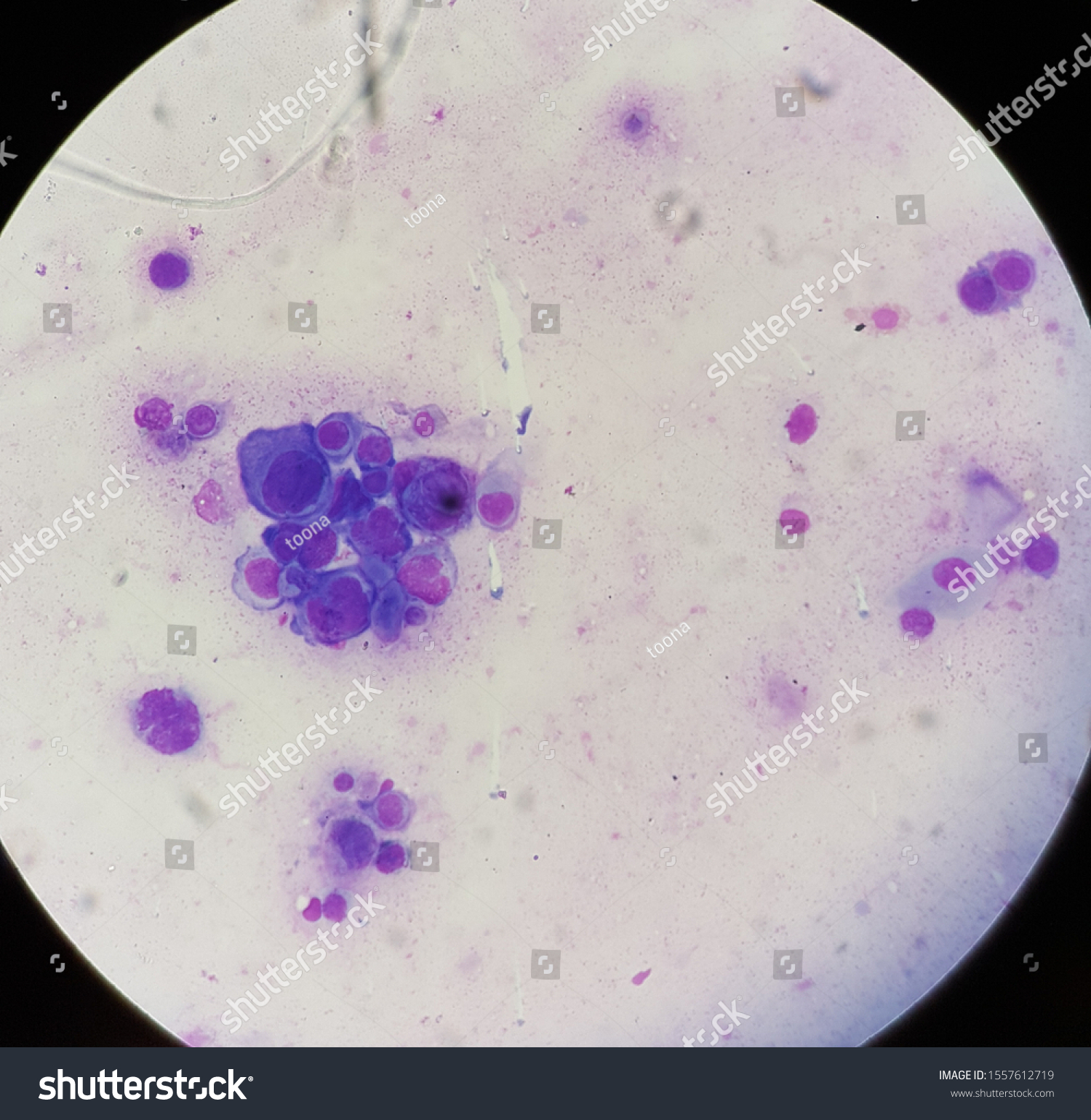 tzanck smear vzv