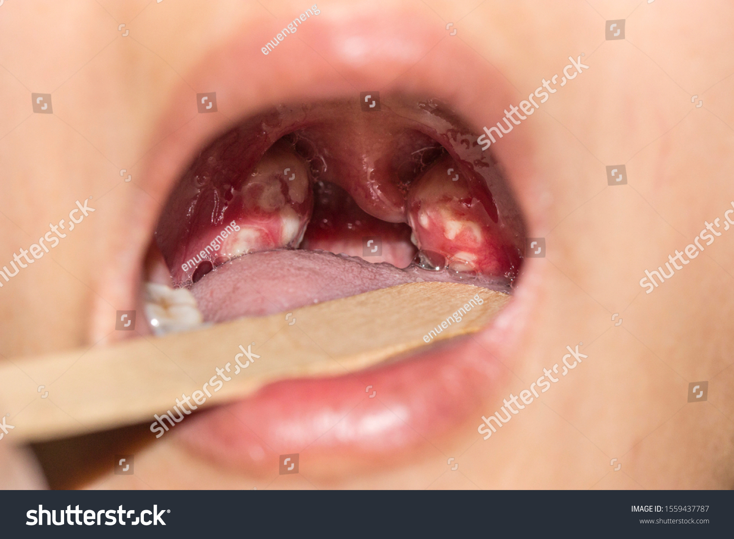 gonorrhoea-tonsillitis-large-tonsils-inflamed-purulent-stock-foto