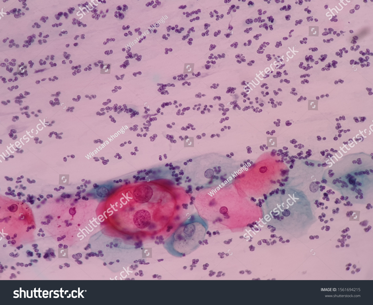Human Papilloma Virus View Microscopy Koilocytes Stock Photo 1561694215