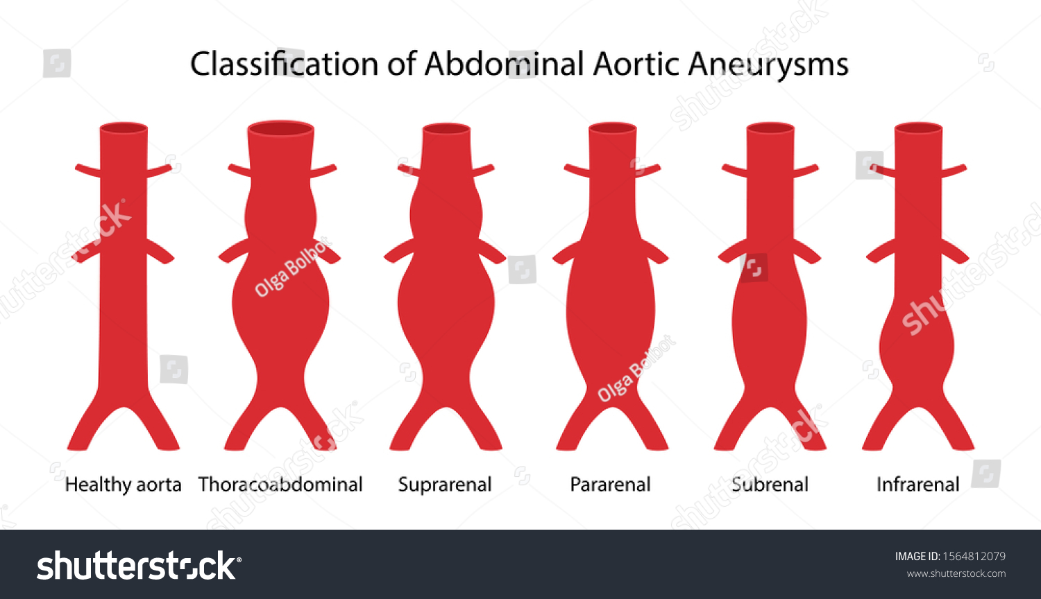 Vektor Stok Classification Abdominal Aortic Aneurysms Healthy Abdominal Tanpa Royalti 7378