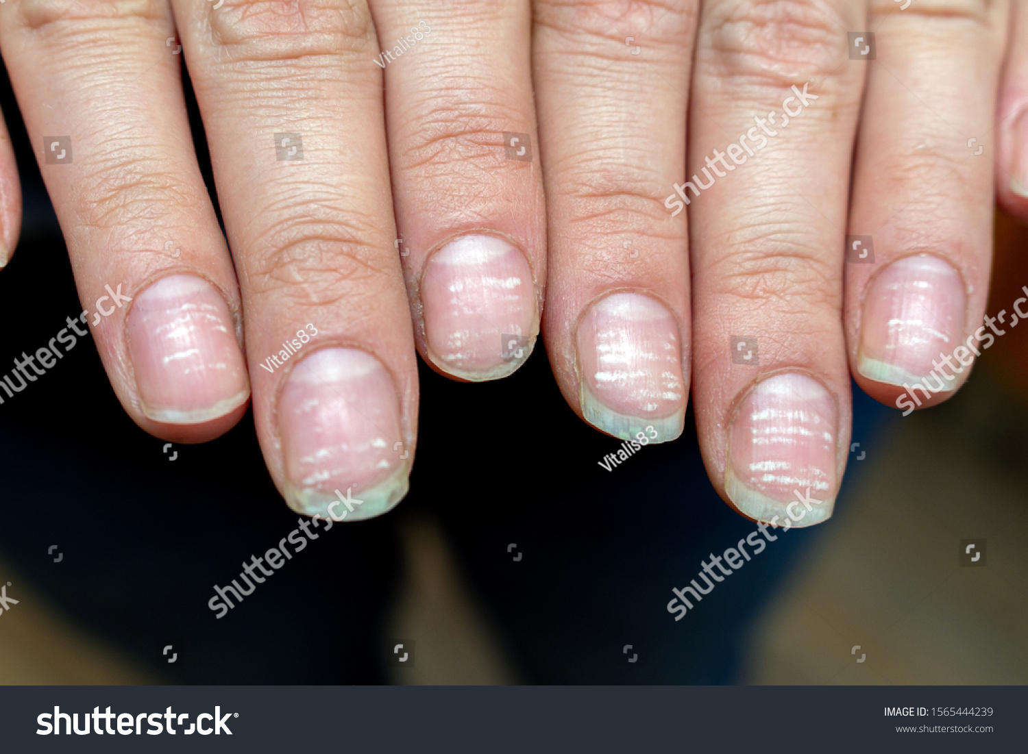 10. Nail Bed Color and Hemolytic Anemia - wide 7