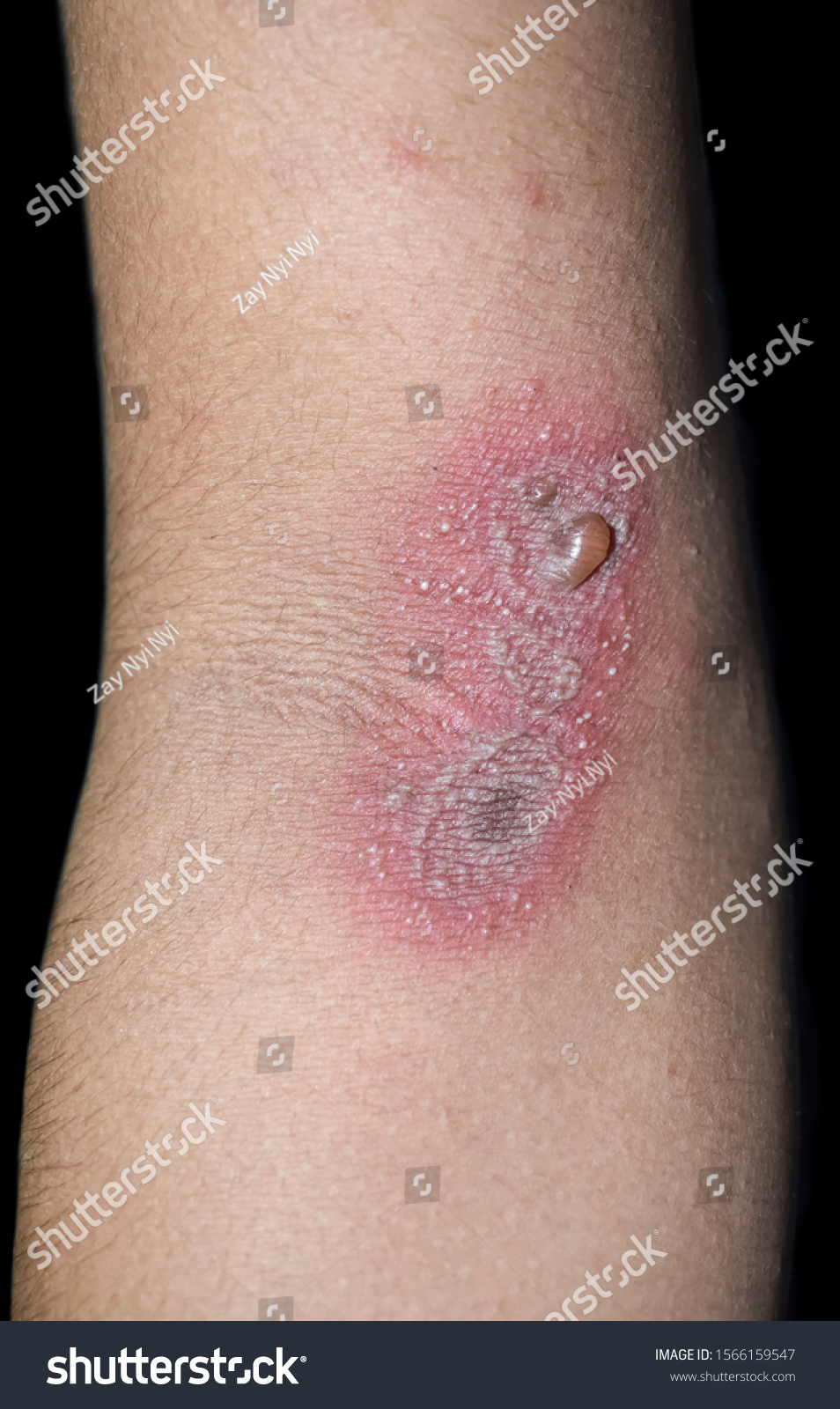 reddened-patch-vesicles-blister-on-elbow-foto-stock-1566159547