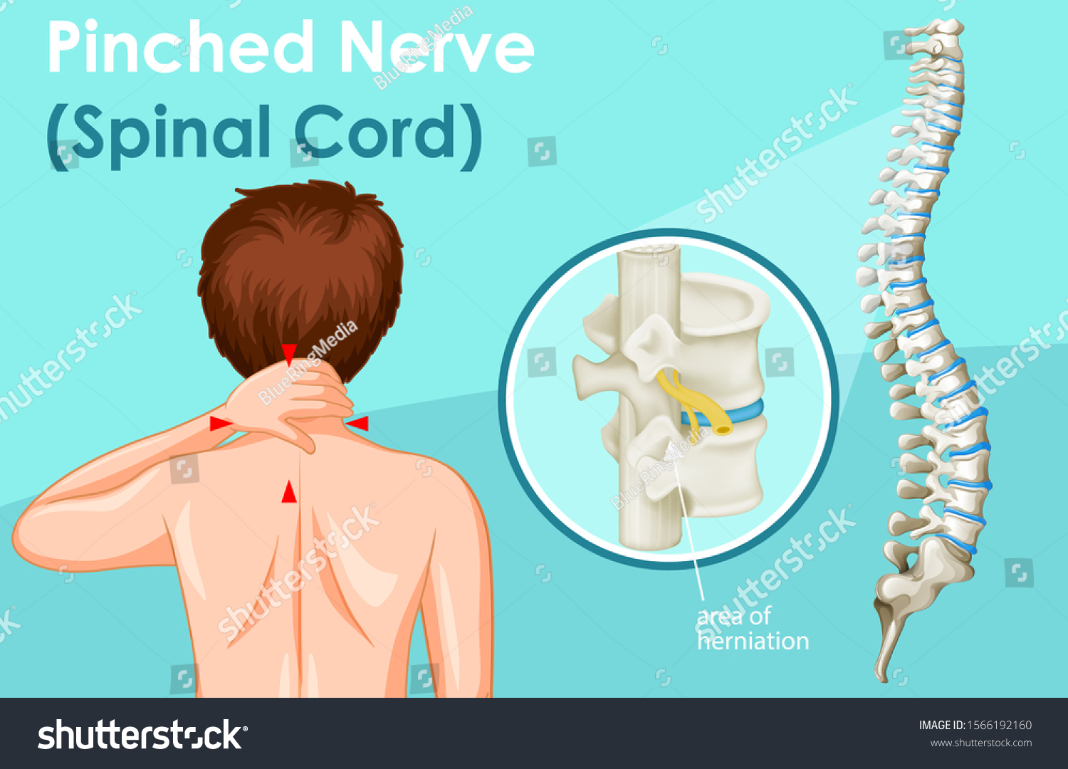 diagram-showing-pinched-nerve-human-illustration-vector-de-stock