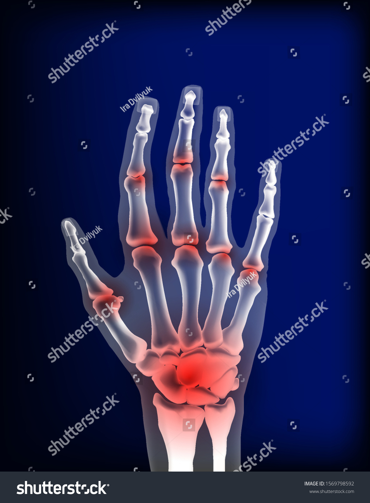 Osteoarthritis Image Sore Inflammation Joints Bones Stock Vector ...