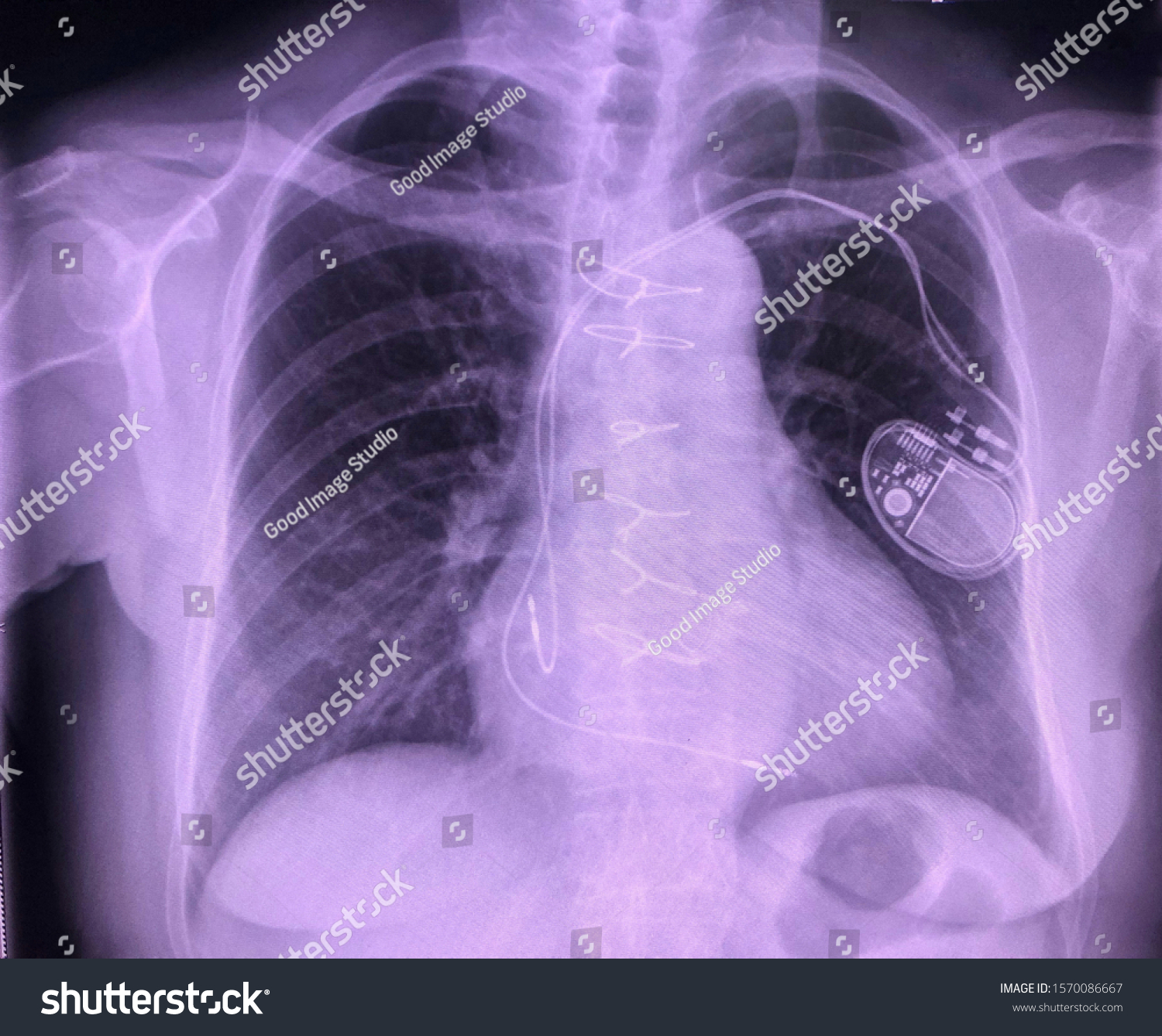 Chest Xray Pacemaker Implantation Stock Photo 1570086667 | Shutterstock