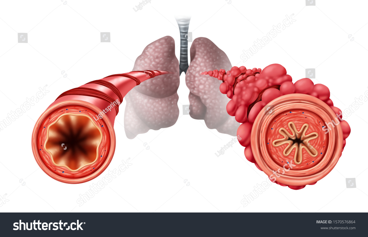 Popcorn Lung Condition Concept Obliterative Bronchiolitis