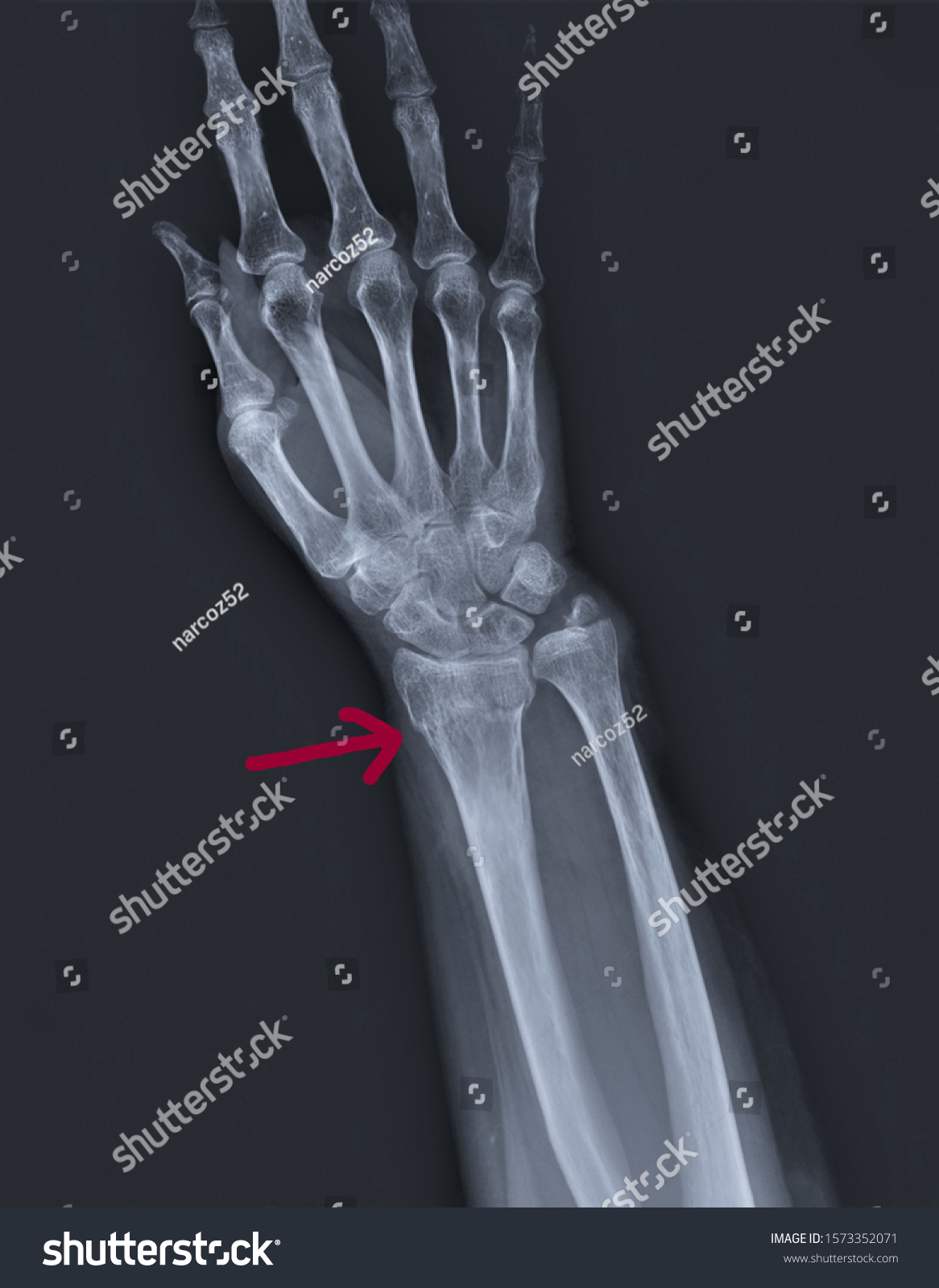 Radiography Forearm Wrist Bones Fracture Distal Stock Photo 1573352071 ...